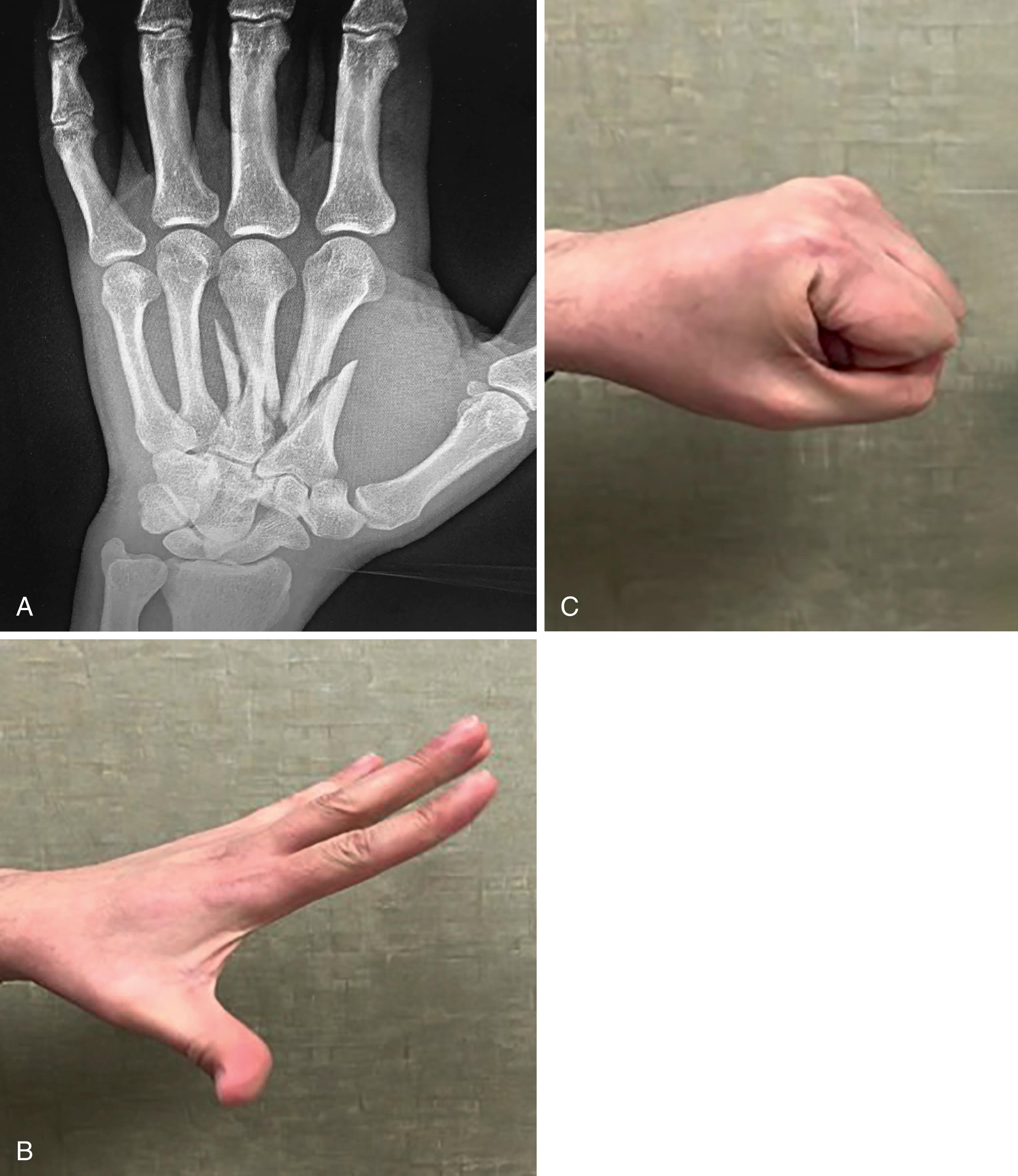 Fig. 7.18, A, Hand AP demonstrating index and long finger metacarpal fractures with shortening. B and C, Clinical photos showing excellent range of motion. The patient returned to all activities without pain.