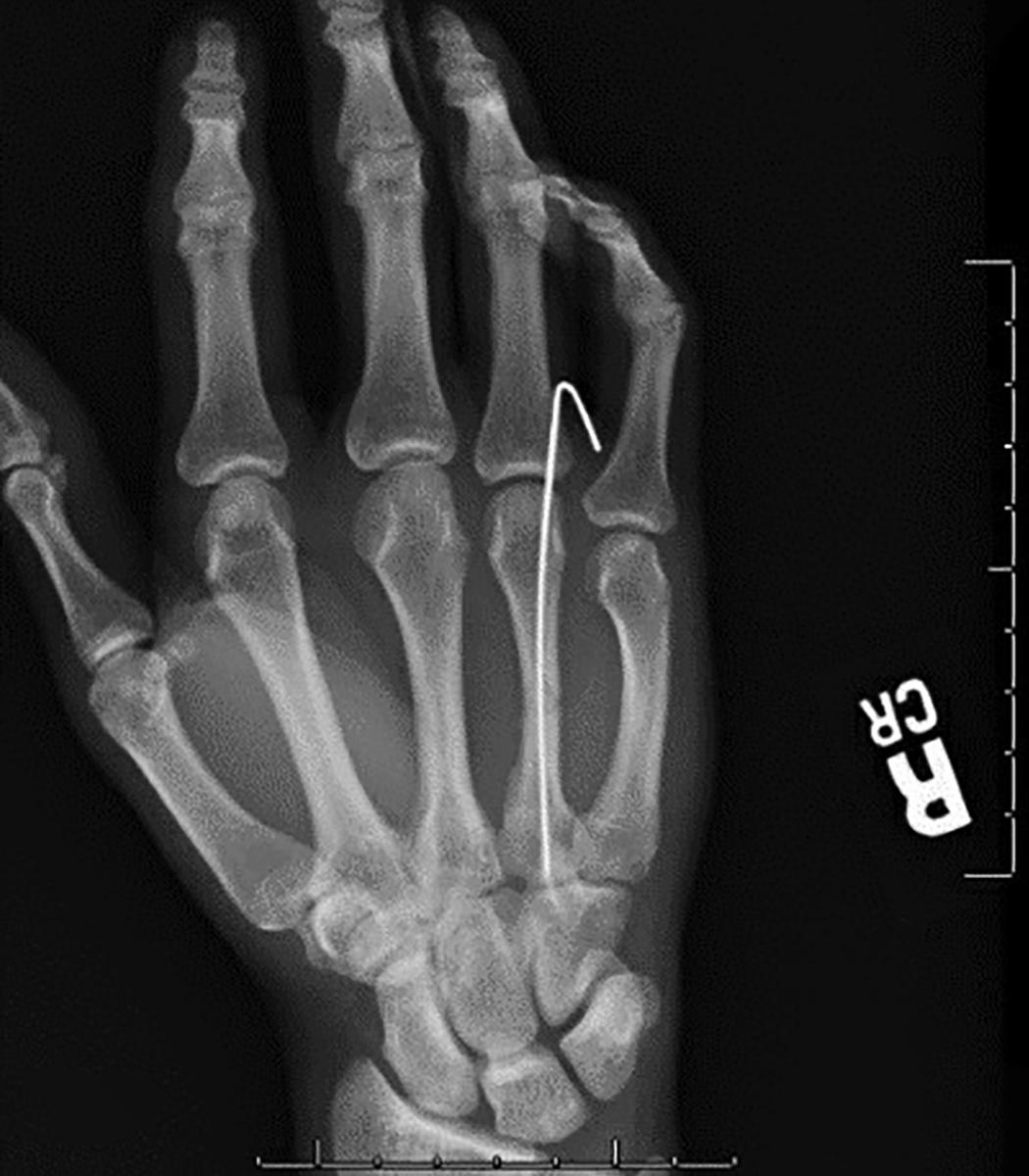 Fig. 7.20, A fourth metacarpal shaft fracture managed with retrograde percutaneous pinning under WALANT in the office.