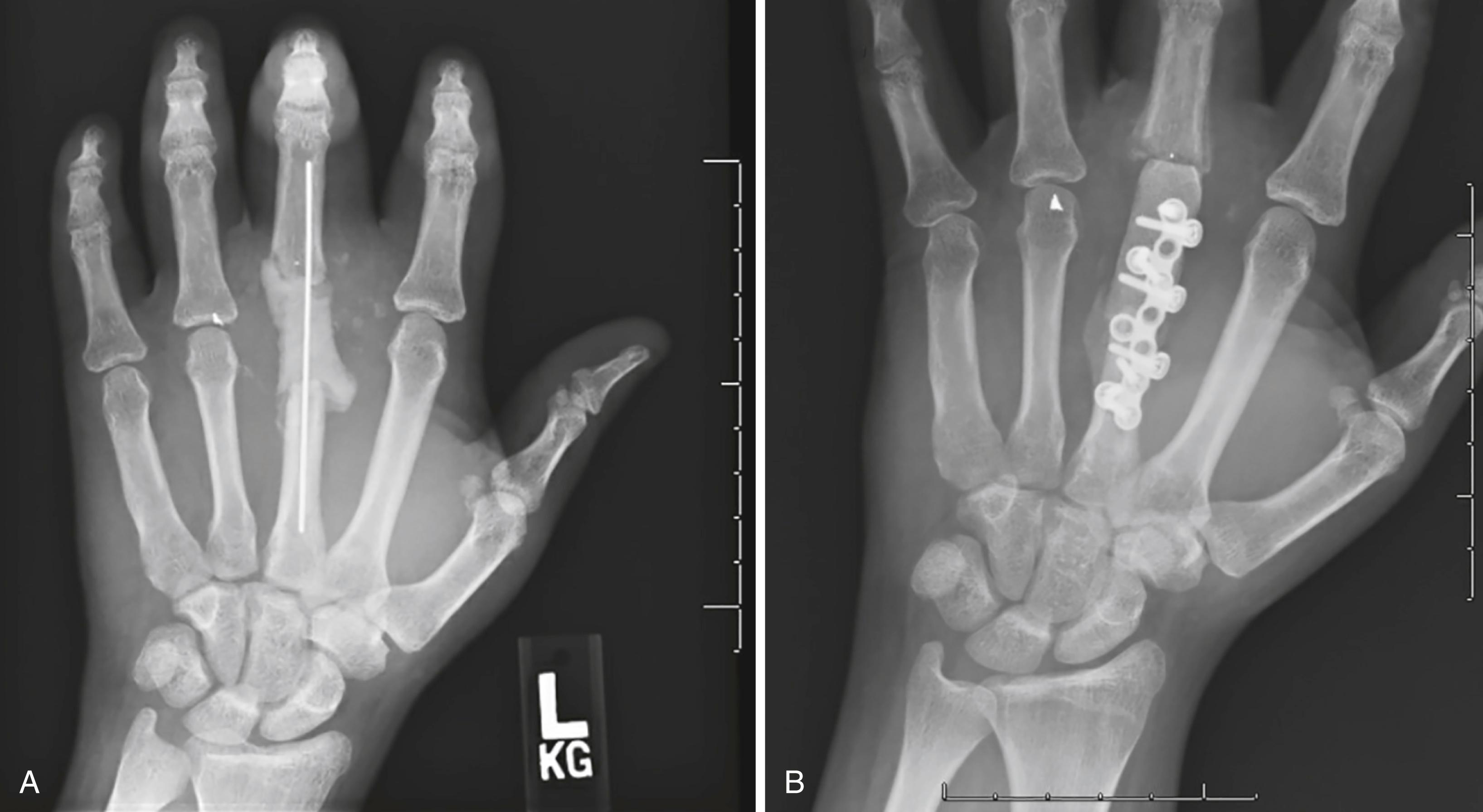 Fig. 7.2, A, A comminuted metacarpal head fracture from a gunshot wound temporized with an antibiotic spacer and maintaining volar plate distally. B, Spacer removed and an iliac crest bone graft placed with interposed volar plate distally to allow ultimately a 50-degree arc of painless motion.