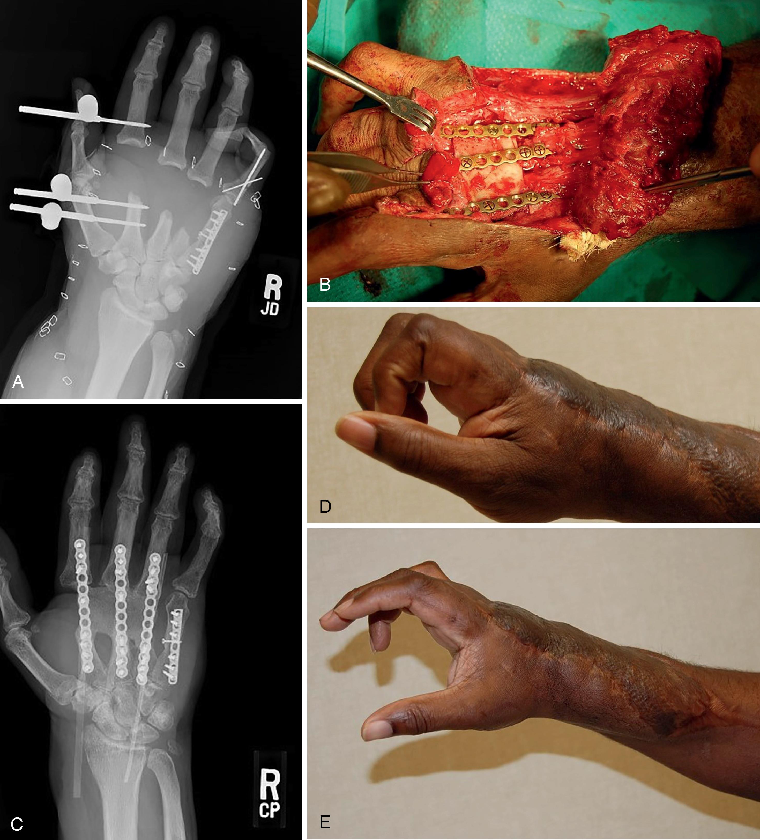 Fig. 7.21, A, Preoperative radiograph demonstrating extensive metacarpal bone loss of the radial three digits following an industrial accident. B, Intraoperative image of a large tricortical iliac crest bone graft in place and plates being applied. C, Postoperative radiograph demonstrating the use of a single large tricortical iliac crest bone graft to span the bony defect and fuse the radial three MCP joints. Hunter rods were placed with subsequent extensor tendon reconstruction. D and E, Clinical outcome of the case demonstrating acceptable restoration of digital motion.