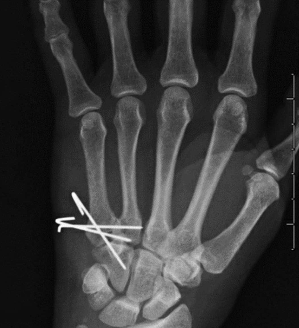 Fig. 7.22, A fifth CMC joint fracture-dislocation stabilized with pinning of the metacarpal base to the hamate followed by transverse pinning into the fourth metacarpal base.