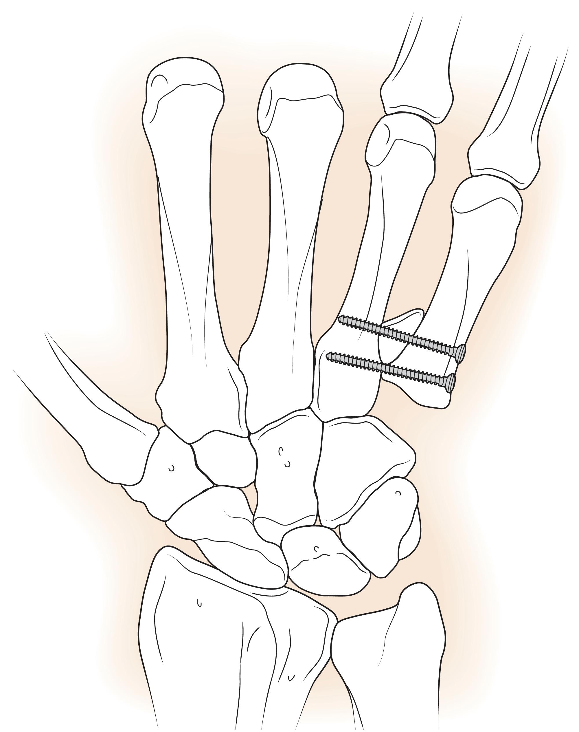 Fig. 7.23, Schematic drawing of the Dubert procedure involving resection of the fifth metacarpal base with side to side fusion of the fourth and fifth metacarpals.