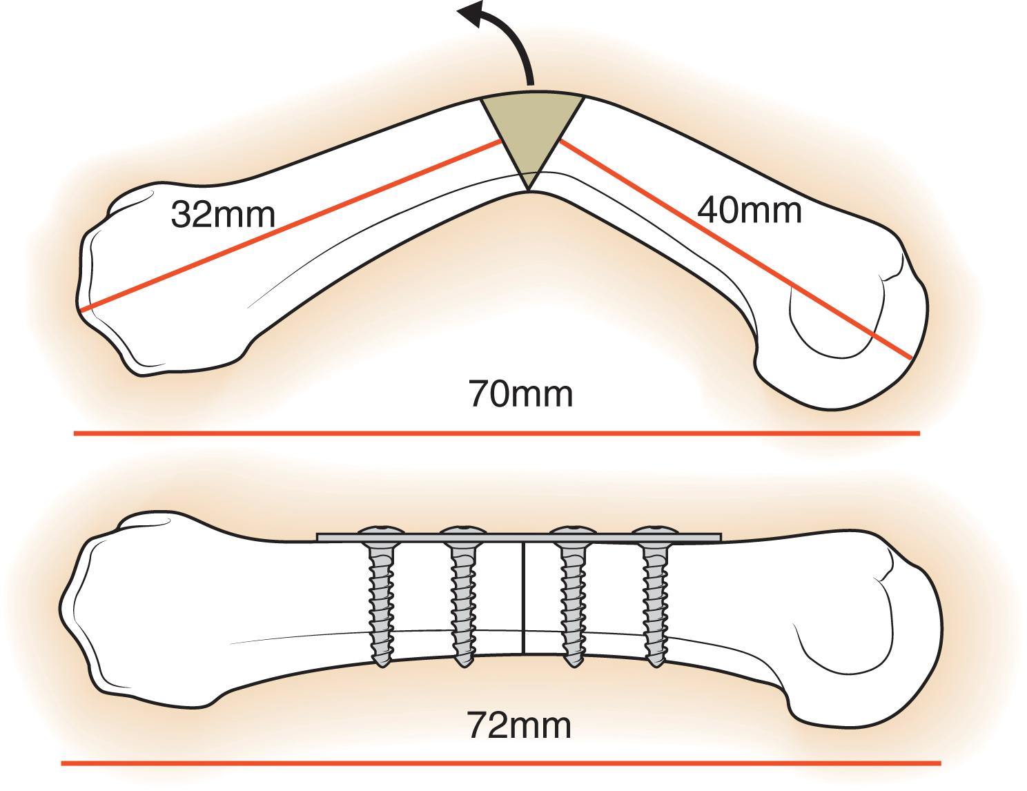 Fig. 7.24, Schematic drawing illustrating a closing wedge osteotomy and highlighting the fact that an increase rather than a decrease in metacarpal length is achieved.