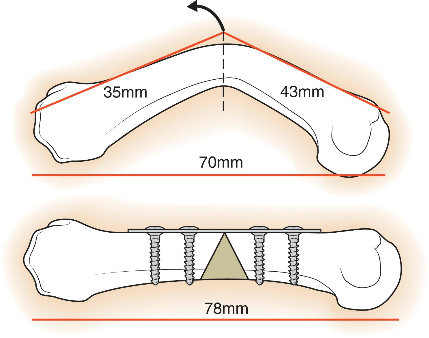 Fig. 7.25, Schematic representation of a volar opening wedge osteotomy of the metacarpal.