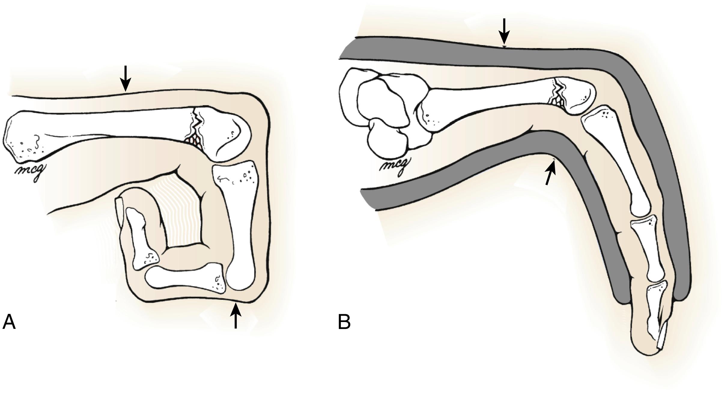 Fig. 7.3, A, Jahss maneuver for reduction of metacarpal neck fracture. Arrows indicate direction of pressure application for fracture reduction. B, After reduction, fingers are held in intrinsic-plus (safe) position in ulnar gutter splint with molding as indicated by arrows.