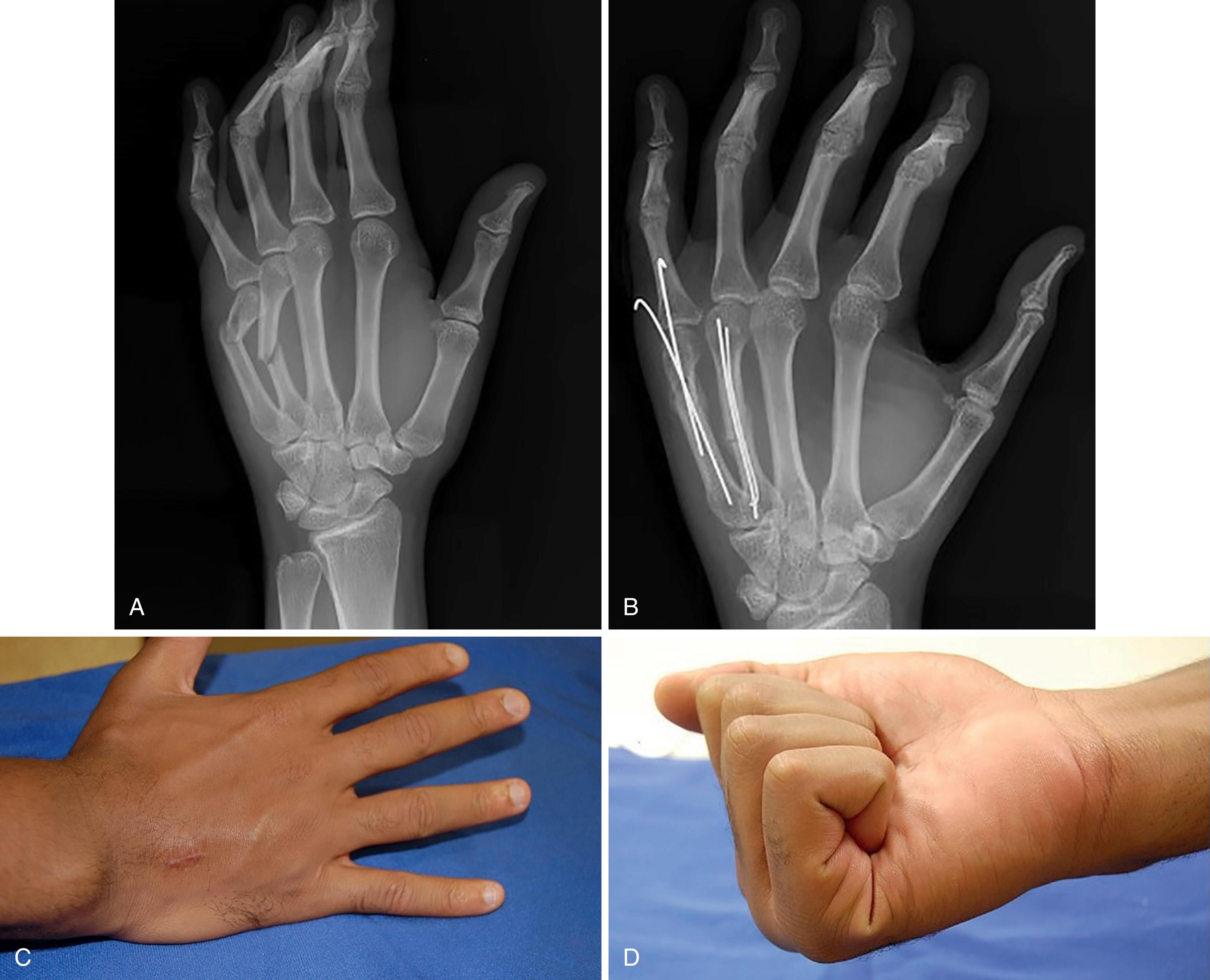 Fig. 7.4, A, Preoperative oblique hand radiograph demonstrating displaced fourth and fifth metacarpal fractures. B, Postoperative oblique x-ray demonstrating percutaneous pinning of the fifth metacarpal neck fracture and intramedullary pinning of the fourth metacarpal shaft fracture. C and D, Clinical results showing full restoration of digital range of motion and the small incision at the base of the fourth metacarpal used for pin introduction.