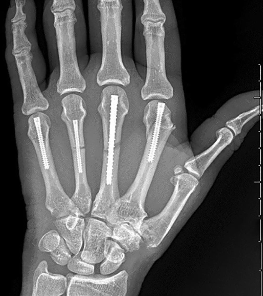 Fig. 7.5, Intramedullary screw fixation of metacarpal neck fractures of the index and long finger and metacarpal shaft fractures of the long and ring fingers.