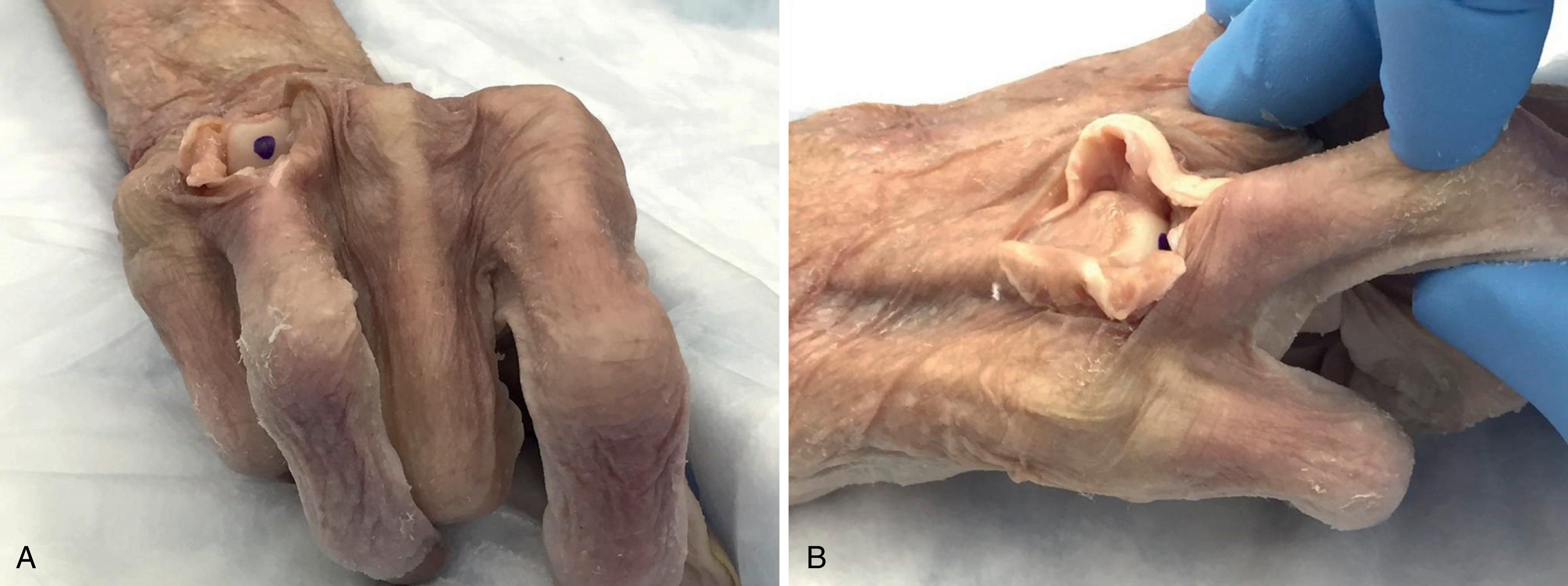 Fig. 7.6, Cadaveric specimens with a dot placed at the proper entry point for the IM screw. In 20 degrees of flexion (A) there is no contact between the base of the proximal phalanx and the entry point. In 20 degrees of hyperextension (B) contact is noted.