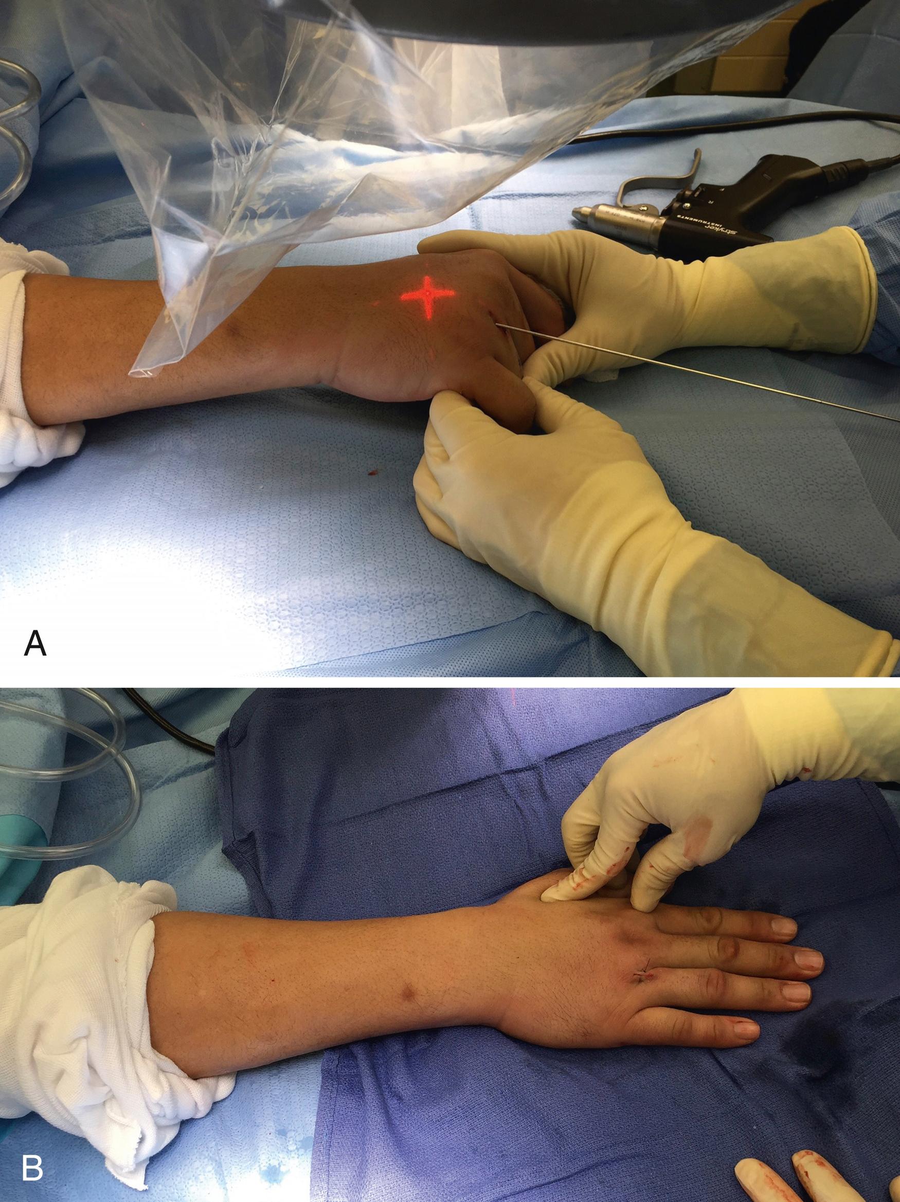 Fig. 7.7, A, Guidepin placement using fluoroscopic guidance for IM screw of a fourth metacarpal fracture. B, Clinical appearance of the limited approach required for IM screw placement.