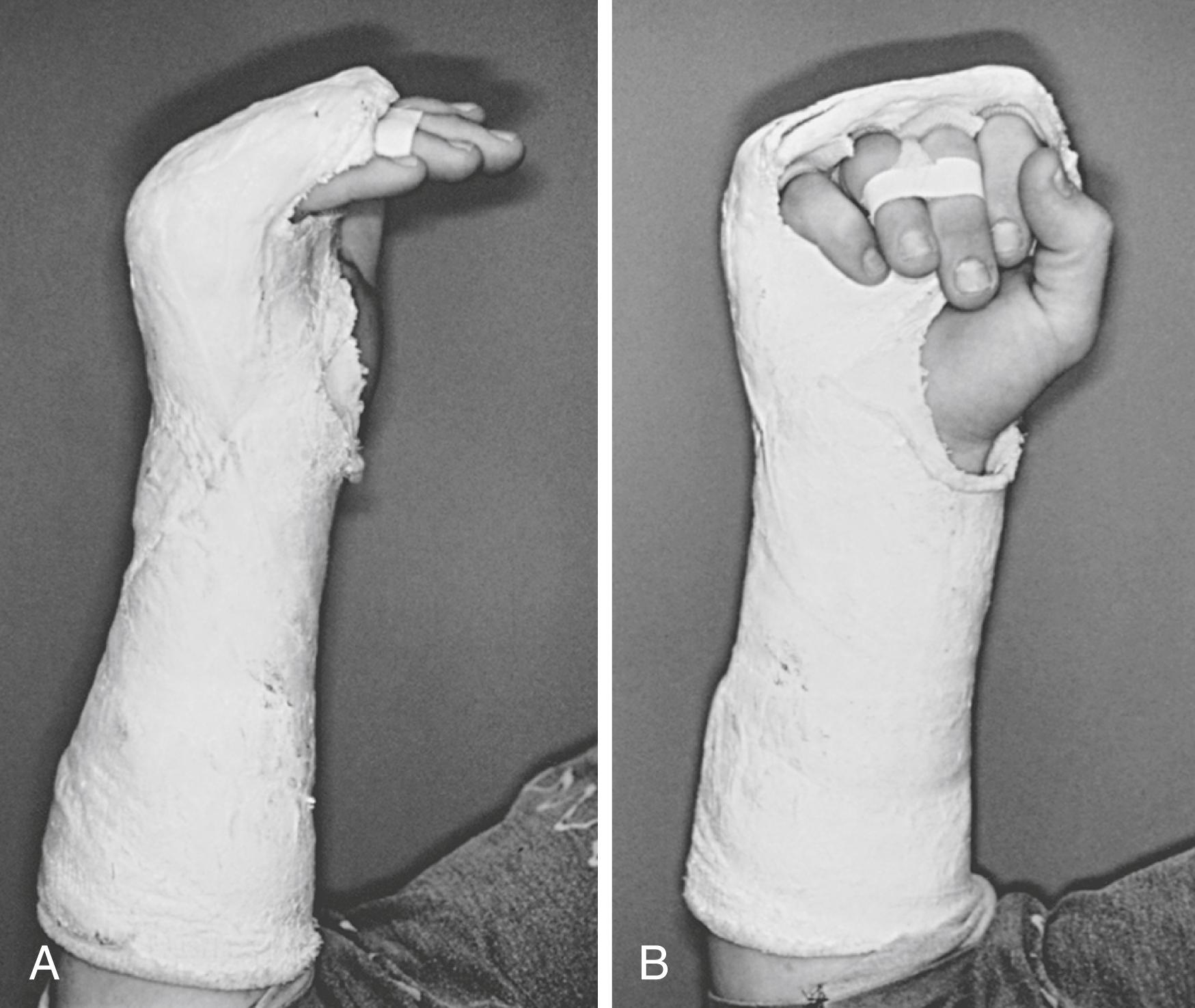 Fig. 7.8, A and B, Clam-digger cast for metacarpal shaft fracture. Wrist is extended 30 degrees, MCP joints are flexed 80 to 90 degrees and IP joints are extended. Active range of motion is encouraged, and supplemental “buddy taping” can help control rotation.