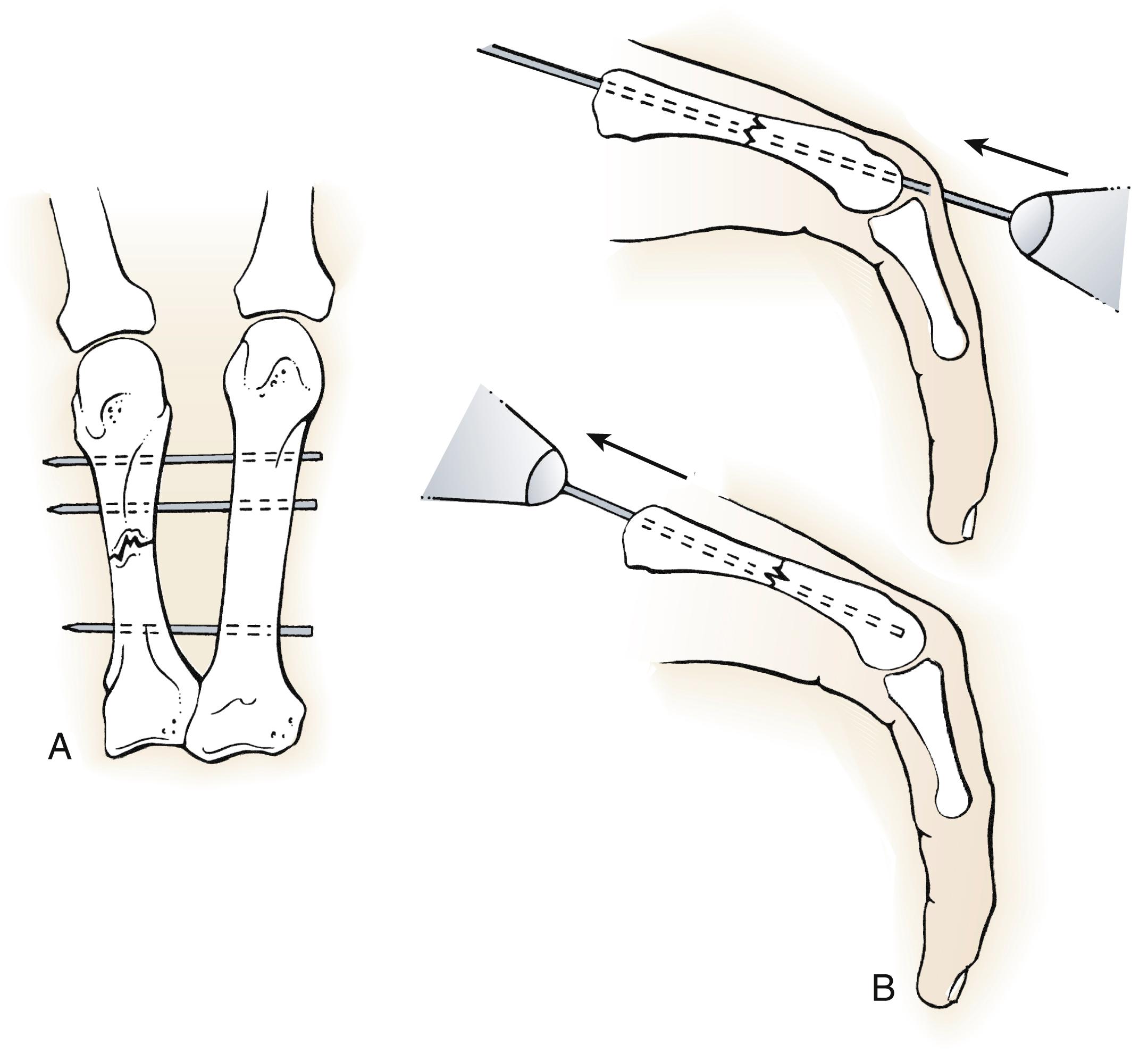 Fig. 7.9, Techniques for Kirschner pin fixation of metacarpal shaft fractures. A, Transverse pins may be inserted percutaneously or open. B, Retrograde intramedullary fixation. Pins can be backed out so that they do not remain in MCP joint.