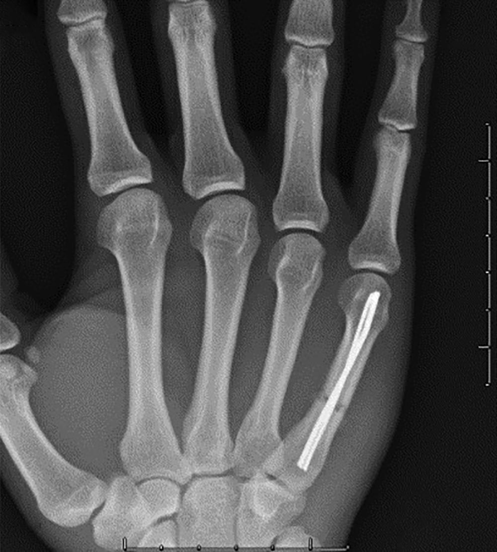 Fig. 7.10, Intramedullary antegrade pinning of a fifth metacarpal shaft fracture.