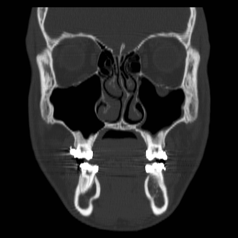 Fig. 187.5, Coronal scan of a trapdoor fracture of the left eye; note the “hanging drop” sign and small, nondisplaced fracture.