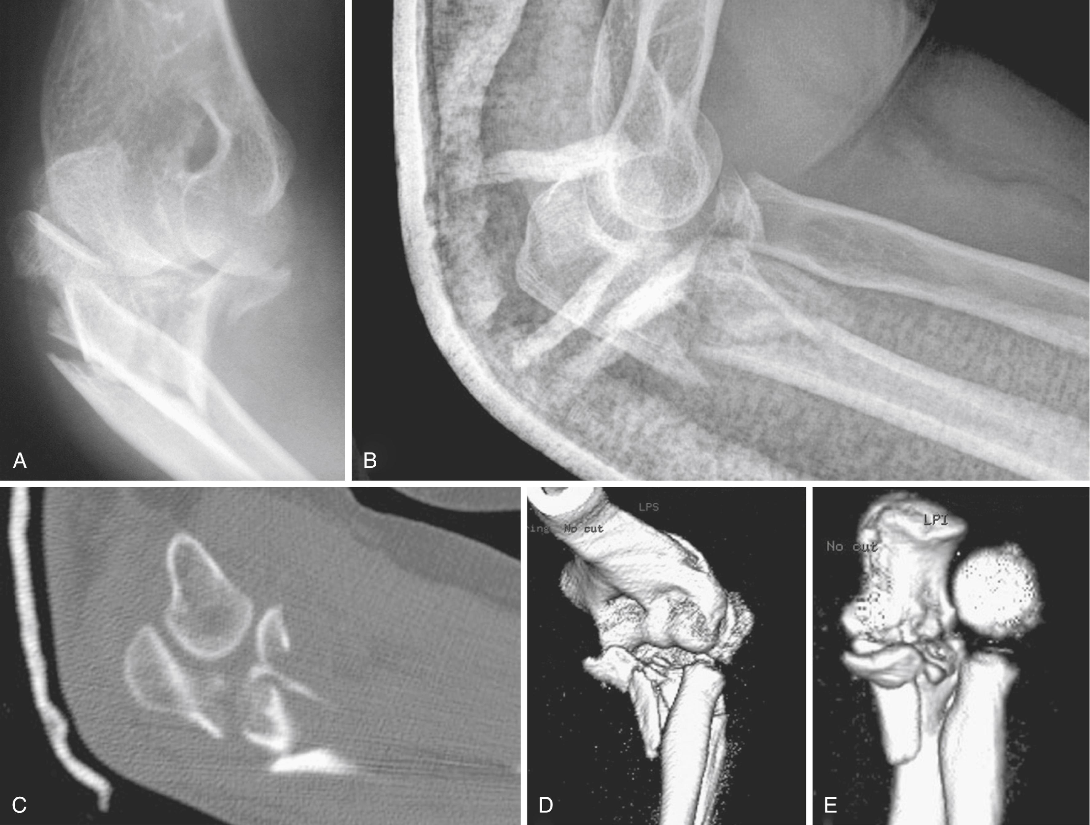 Fig. 20.1, Imaging of complex proximal ulnar fractures. A, A radiograph taken immediately after the injury, before manipulative reduction, gives important information about the injury pattern and displacement. B, After manipulative reduction and splinting, the characteristics of the fractures may be more apparent. C, Two-dimensional CT scanning can show greater detail, but it can be difficult to follow specific fracture fragments between images. D, Three-dimensional reconstructions of CT images can be easier to interpret, particularly after the distal humerus has been removed from the image (E).