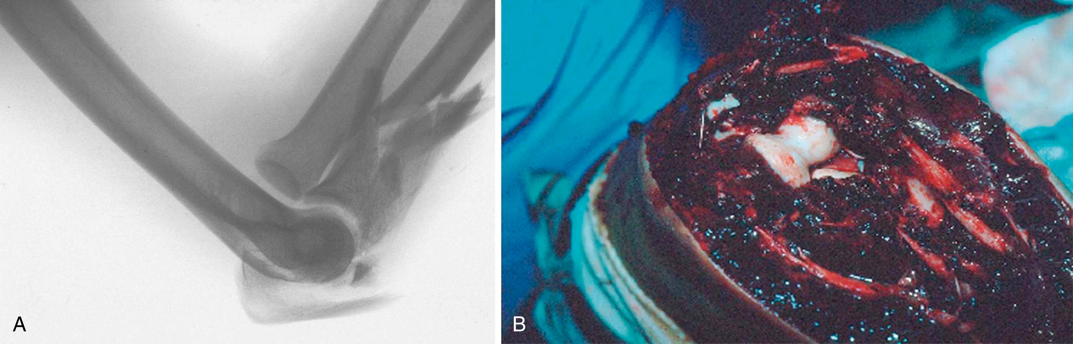 eFig. 20.4, A, The forearm is displaced anteriorly, with the radioulnar relationship relatively spared. B, The trochlea has imploded through the proximal ulna, creating a very complex fracture with a large coronoid fracture and comminution extending into the diaphysis. The collateral ligaments are usually not injured.