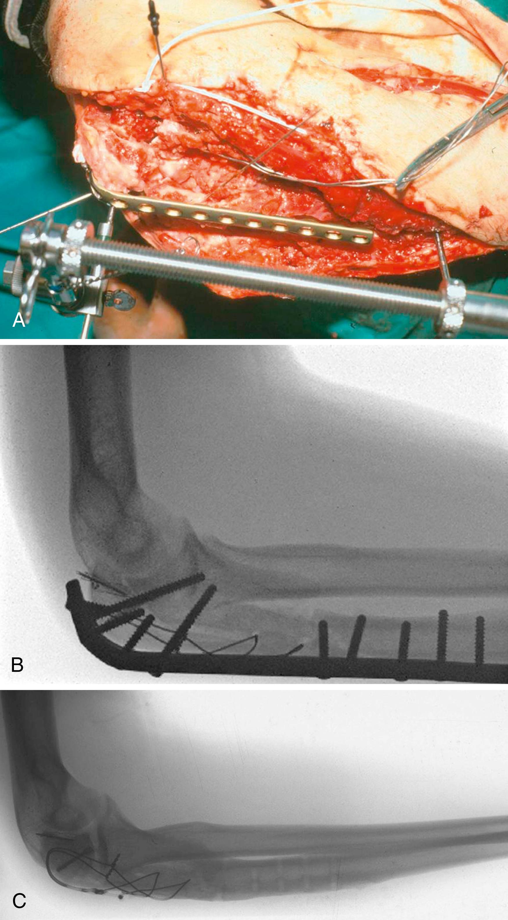 eFig. 20.5, A, As described by Dr. Jeff Mast, an external fixator can assist with reduction and provisional fixation. B, A long contoured dorsal plate secures the relationship between the coronoid and olecranon processes (the contour and dimensions of the trochlear notch) and bridges the comminution. A tension wire engages the fragmented olecranon process. C, Radiograph after plate removal.