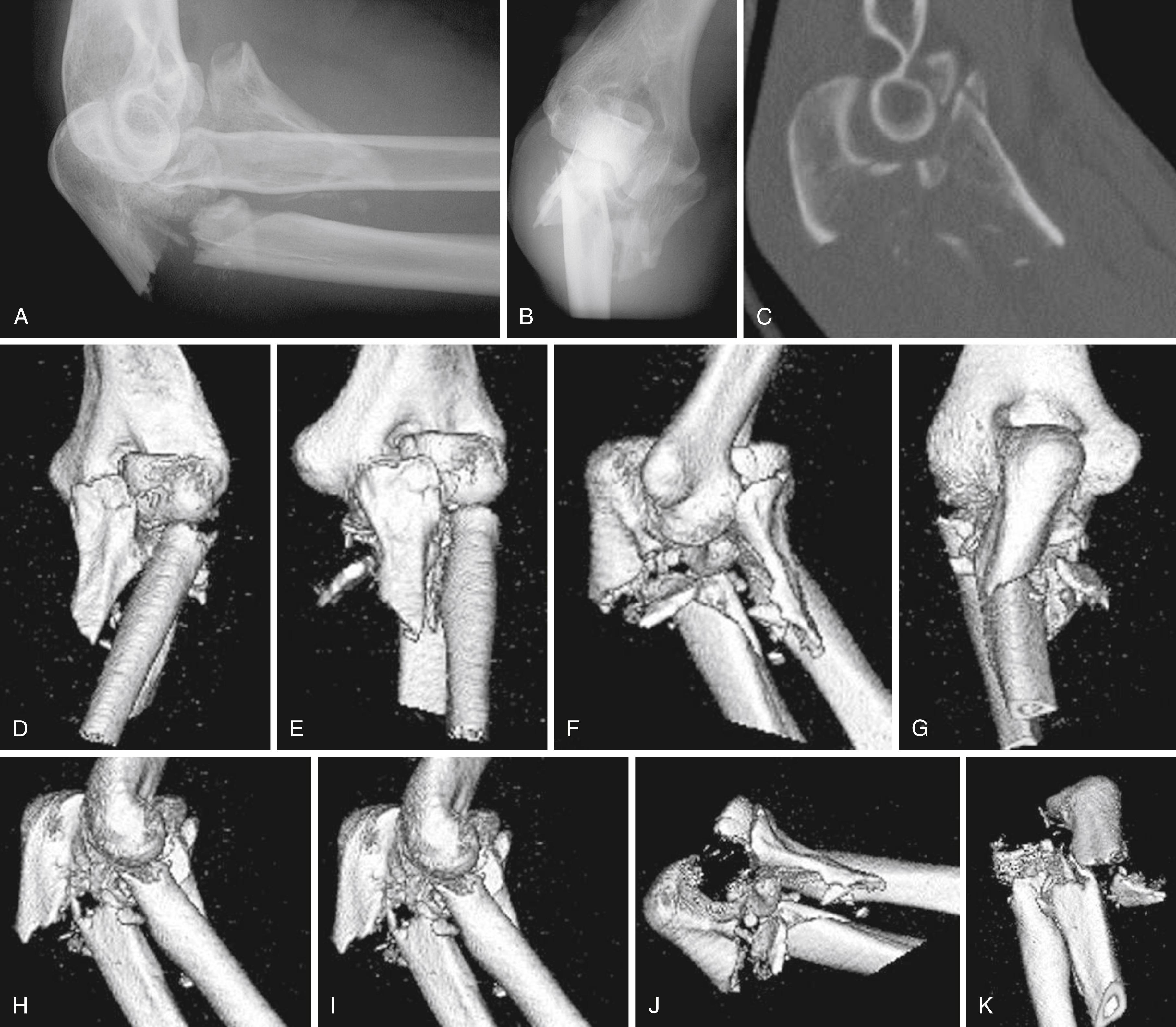 eFig. 20.9, A and B, Lateral and anteroposterior radiographs after injury show an apex posterior ulnar fracture, a large coronoid fracture, and posterior dislocation of the radial head with fracture. C, Two-dimensional CT scanning is helpful but difficult to interpret. D to K, Three-dimensional CT images with and without the distal humerus are much more easily interpreted. The fractures of the coronoid and radial head are comminuted, but there is a large coronoid facet fragment that can be useful.