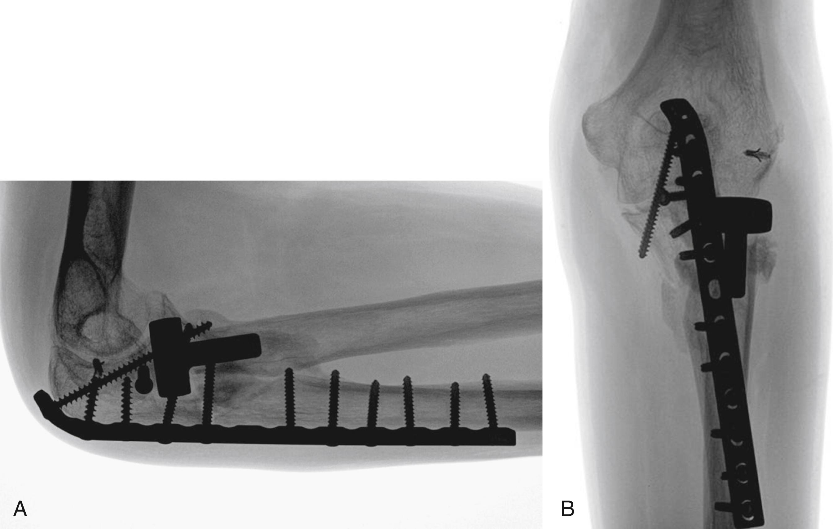 eFig. 20.10, A and B, Postsurgical radiographs.