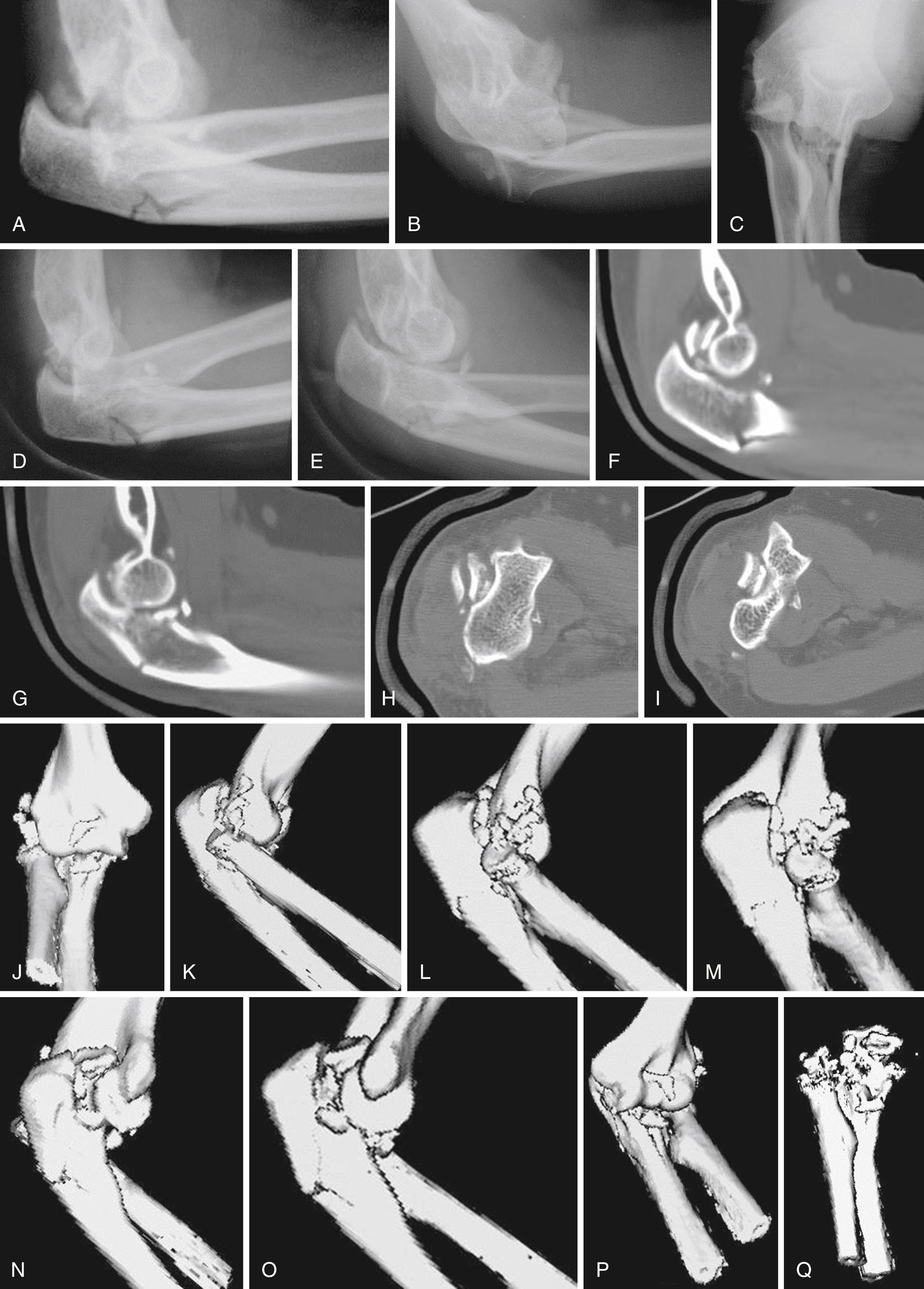 eFig. 20.11, A to C, In this case, the ulna is fractured at the metaphyseal rather than the olecranon level, and the coronoid is fractured at its base. D and E, The coronoid is extremely comminuted, with a major fragment displaced to the posterior aspect of the joint. The ulnar fracture cannot be opened up to expose the coronoid in this case; the fracture is so distal that the lateral collateral ligament attachment and many of the muscle attachments remain intact. F to I, The two-dimensional CT images show these features in greater detail. In particular, one can see the comminuted fracture of the olecranon with large intraarticular fragments posterior to the trochlea. J to Q, The three-dimensional reconstructions are not as clear for this patient, partly due to the technique of the scan and partly to the complexity of the injury. Nonetheless, they are more straightforward to interpret and provide useful information.