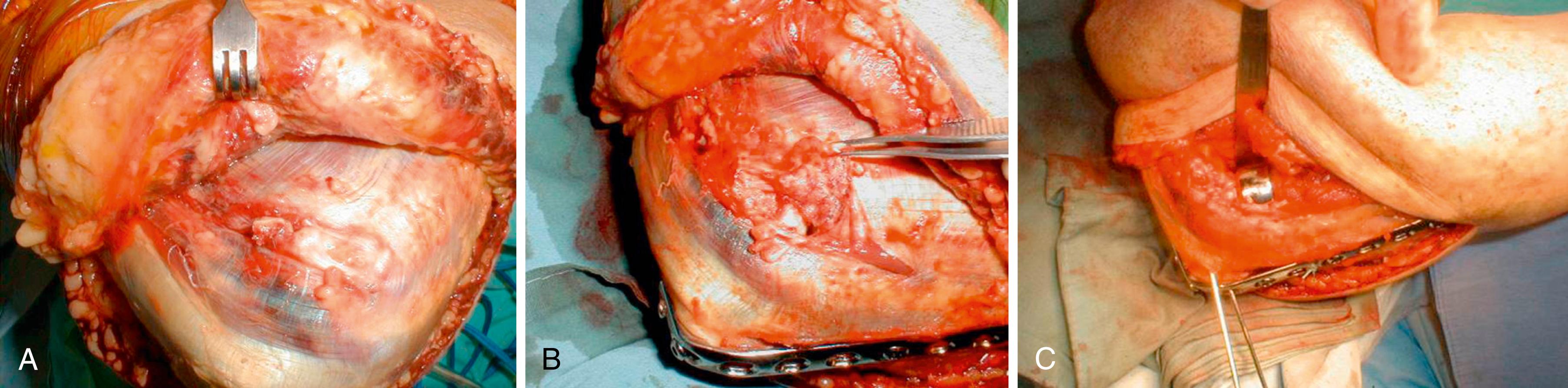 eFig. 20.12, A, Although the lateral collateral ligament and common extensor muscles were avulsed from the lateral epicondyle, there was only a small tear in the common extensor muscles visible after the lateral skin flap was elevated. A piece of the radial head was extruded through this rent. B, The minimally displaced fracture of the proximal ulnar metaphysis was realigned and secured with a dorsal plate and screws. In this case the plate was applied directly over the triceps insertion without incising it. After additional incision of the deep fascia, the underlying injury to the lateral collateral ligament and common extensor origin (the so-called bald or bare lateral epicondyle) is apparent (forceps) . C, The origins of radial wrist extensors (extensor carpi radialis brevis and longus) have been incised to improve exposure of the coronoid. With the radial head removed and the common extensors and supinator split distally, a good view of the coronoid can be obtained. The coronoid could not be repaired. A fragment of the radial head was used to reconstruct the coronoid process, and the radial head was replaced with a metal prosthesis.