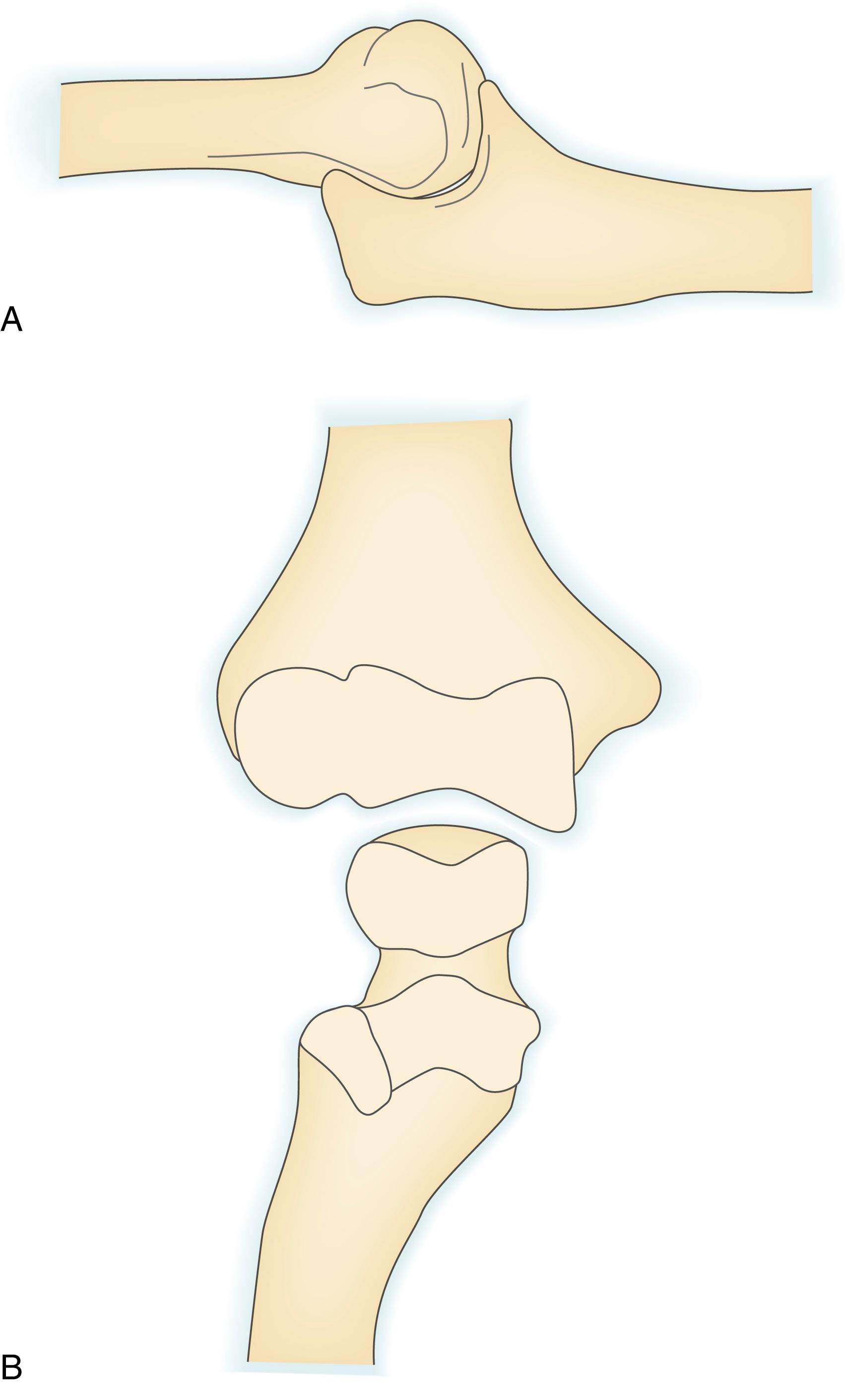 Fig. 20.2, Anatomy of the trochlear notch. A, The trochlear notch of the ulna has a circumference of nearly 180 degrees that tilts somewhat posteriorly. A line drawn between the tips of the olecranon and coronoid processes should create a 30-degree angle with a line parallel to the ulnar shaft. B, The stability of the ulnotrochlear articulation is enhanced by interdigitation of a central ridge in the trochlear notch with a groove in the trochlea. The trochlear notch has separate coronoid and olecranon articular facets with an intervening nonarticular area.