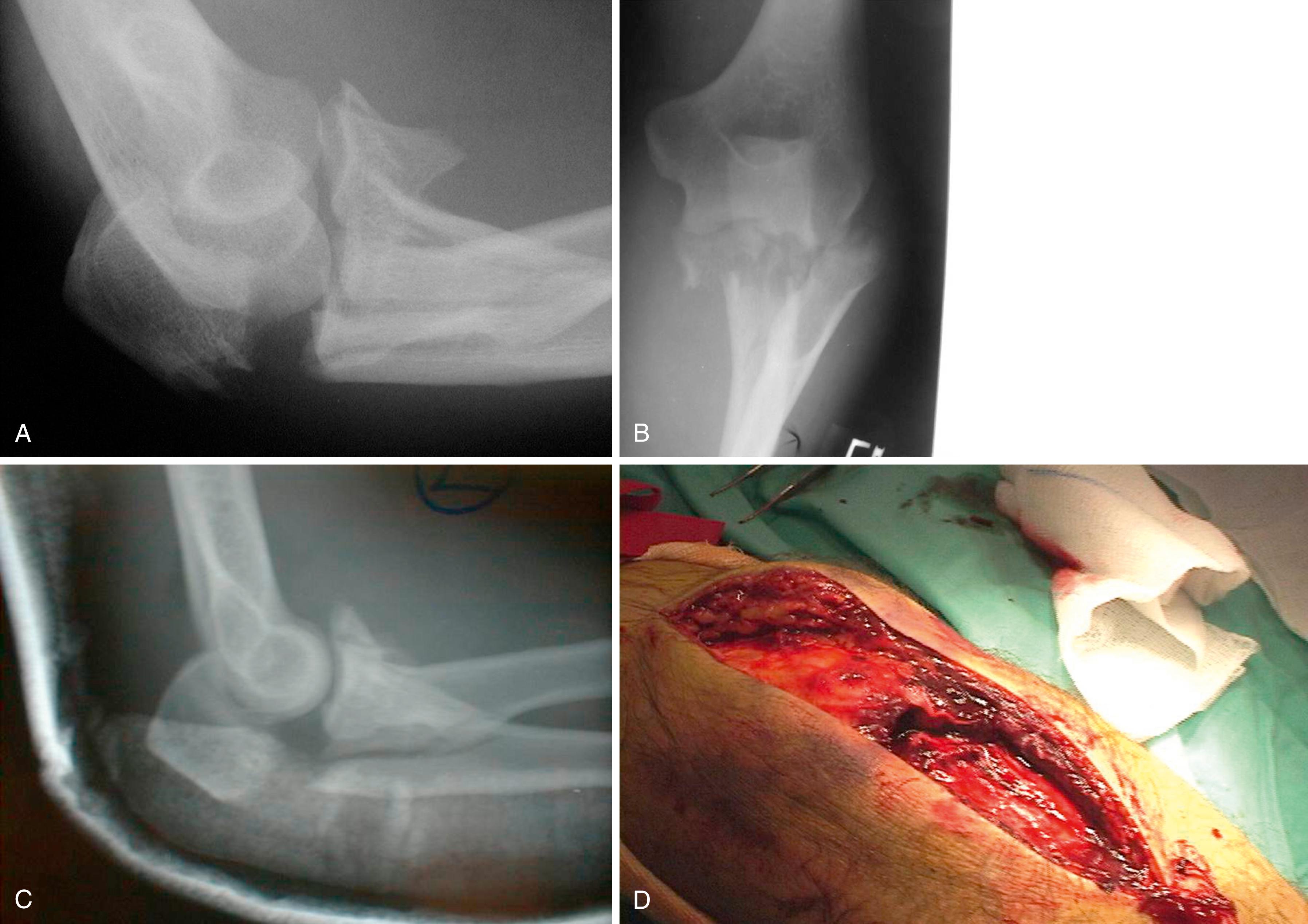 eFig. 20.14, A, Posterior olecranon fracture-dislocations feature fractures of the coronoid and radial head and frequent injury to the lateral collateral ligament complex. B, The anteroposterior radiograph shows that the coronoid is comminuted with a separate anteromedial facet fragment. C, Postreduction radiographs show the injury somewhat better. D, The posterior muscles have been torn by the injury.