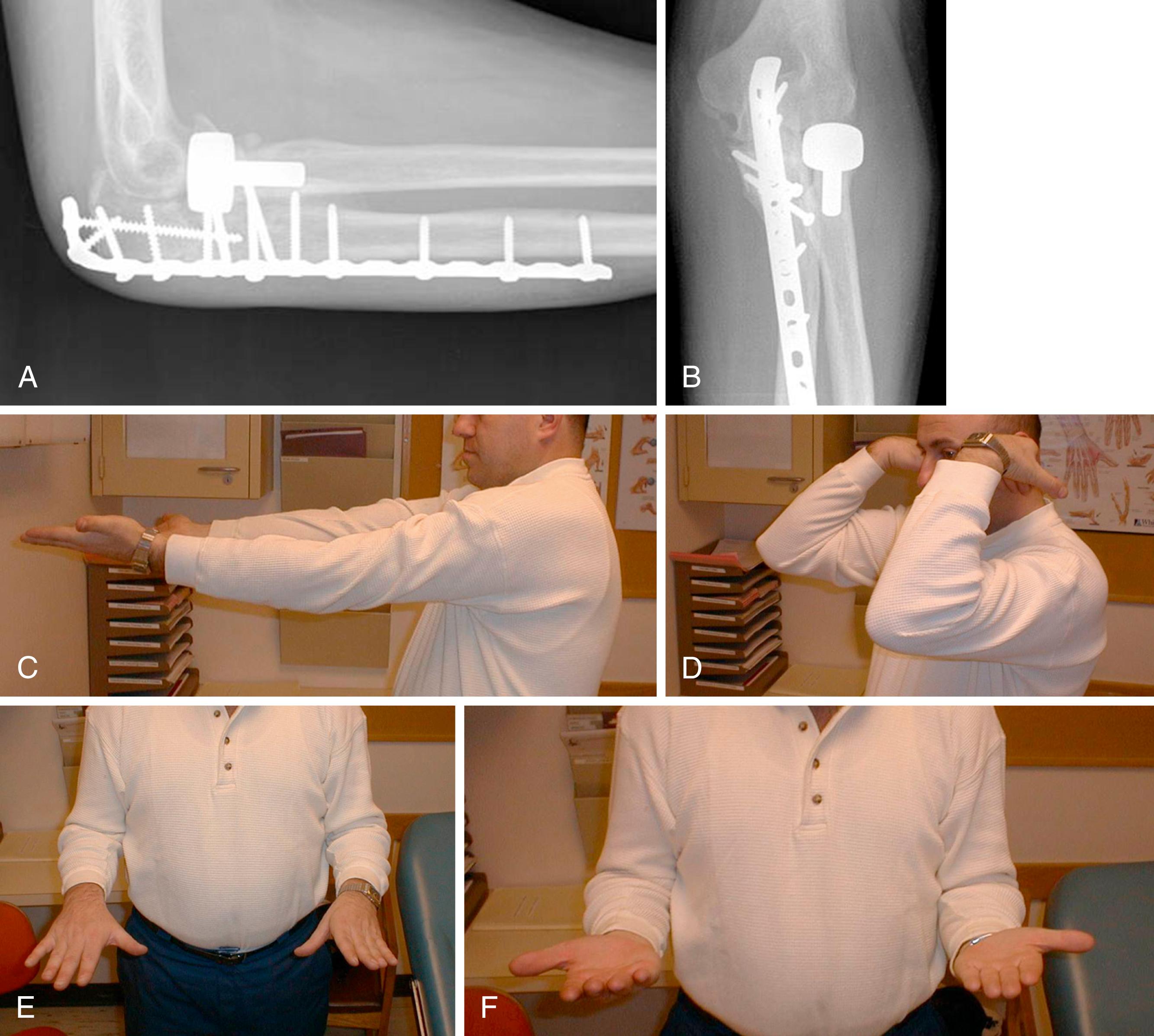 eFig. 20.16, A and B, The fracture healed with good alignment. C to F, Functional motion was obtained.