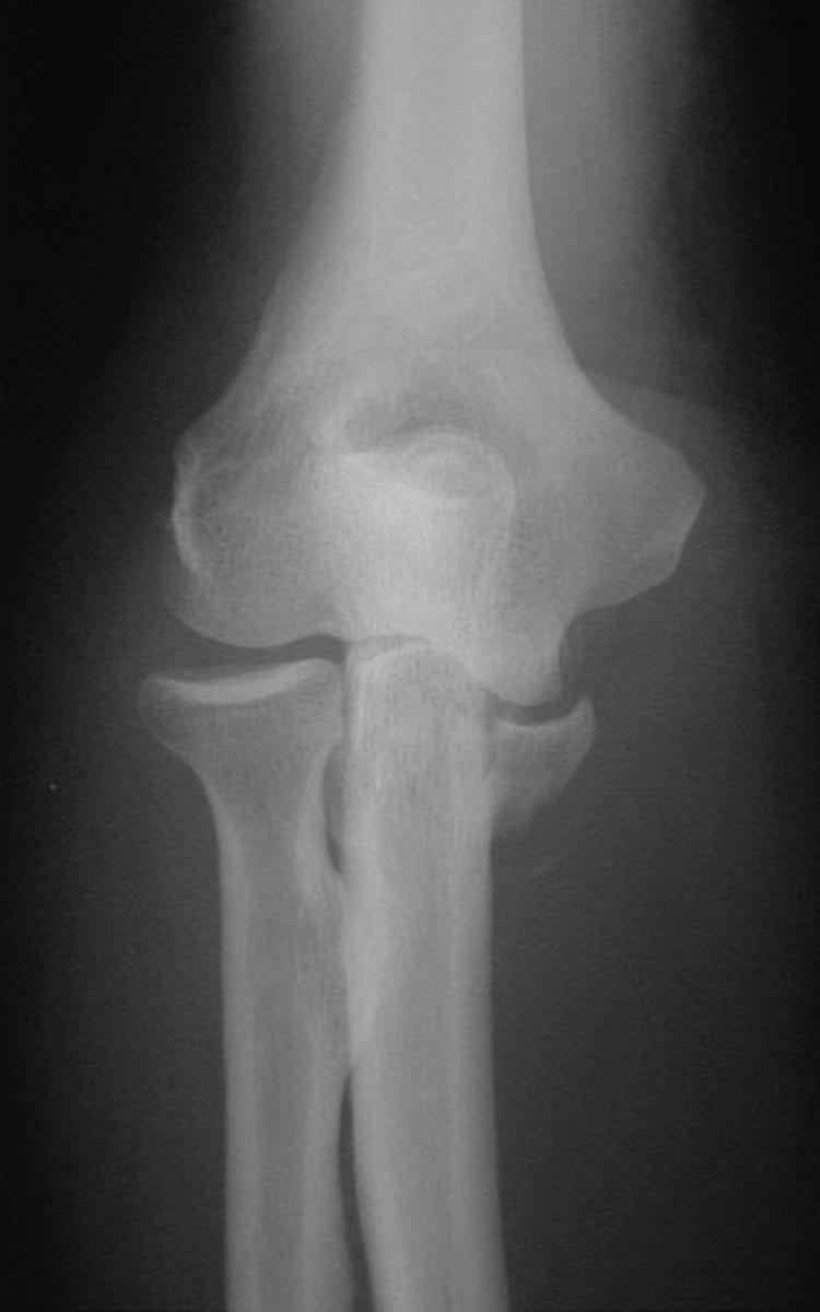 Fig. 20.9, The posteromedial varus rotational instability–pattern injury has only recently been recognized. It is characterized by a fracture of the anteromedial coronoid facet and rupture of the origin of the lateral collateral ligament complex from the lateral epicondyle.