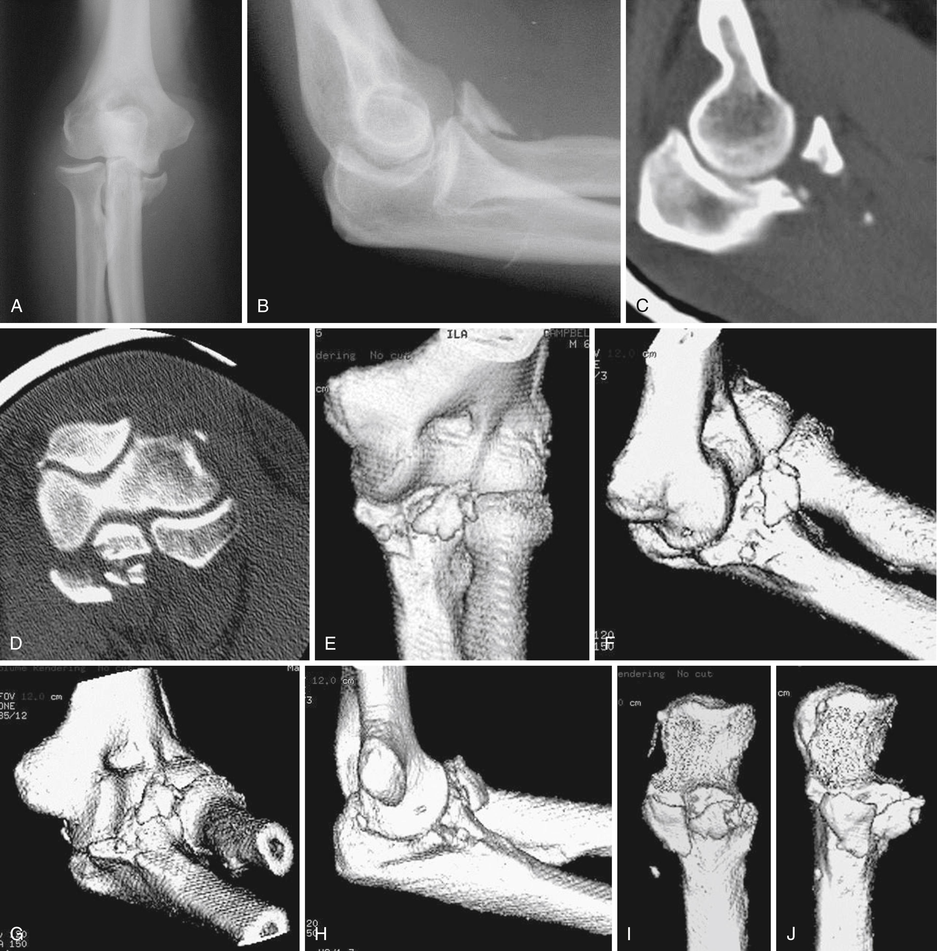 eFig. 20.17, A, The posteromedial varus rotational instability–pattern injury is characterized by a fracture of the anteromedial coronoid facet and rupture of the origin of the lateral collateral ligament complex from the lateral epicondyle. B, The pitfall of this injury is that the lateral view can look relatively innocuous with a Regan and Morrey type II fracture. C and D, Two-dimensional CT shows more detail, but the pattern of the injury is not apparent. E to J, Three-dimensional reconstructions show the separate tip and anteromedial facet fractures. What is not apparent is that the sublime tubercle (insertion point of the anterior band of the medial collateral ligament) was also fractured.