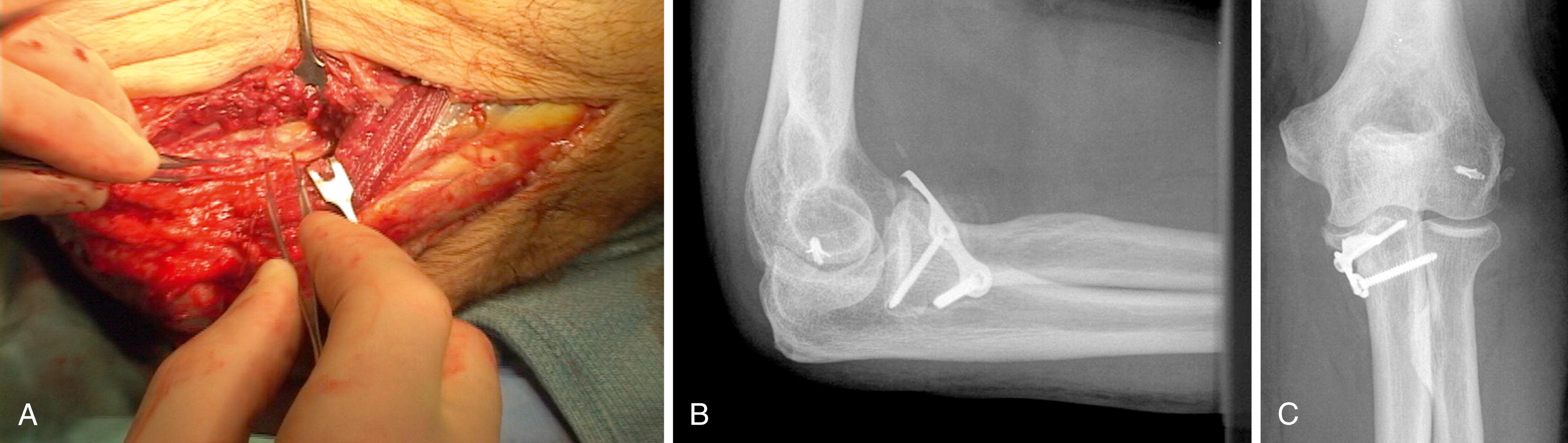 eFig. 20.18, A, The interval between the ulnar and humeral origins of the flexor pronator mass was used for exposure of the coronoid after anterior subcutaneous transposition of the ulnar nerve. The attachment of the medial collateral ligament to the sublime tubercle is preserved. B and C, The coronoid was repaired with a precontoured plate and the lateral collateral ligament was reattached to the lateral epicondyle with suture anchors.