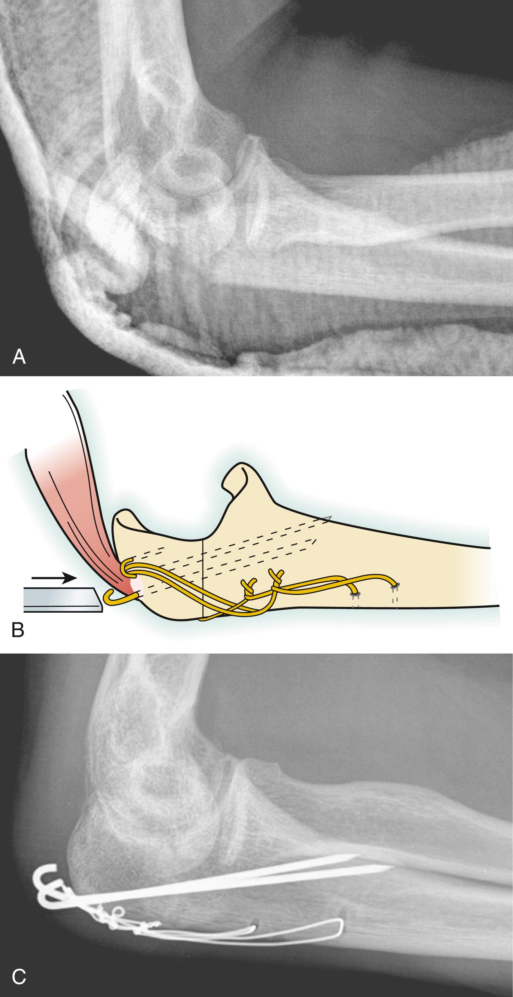 Fig. 20.10, Tension band wiring. A, Tension band wiring is suitable for simple fractures without fracture of the radial head or coronoid or dislocation/subluxation of the ulnohumeral joint. B, A technique using anteriorly oriented Kirschner wires, impaction of the proximal ends into the olecranon beneath the triceps insertion, and two small-gauge tension wires can limit hardware-related problems. C, Active motion is initiated the morning after surgery