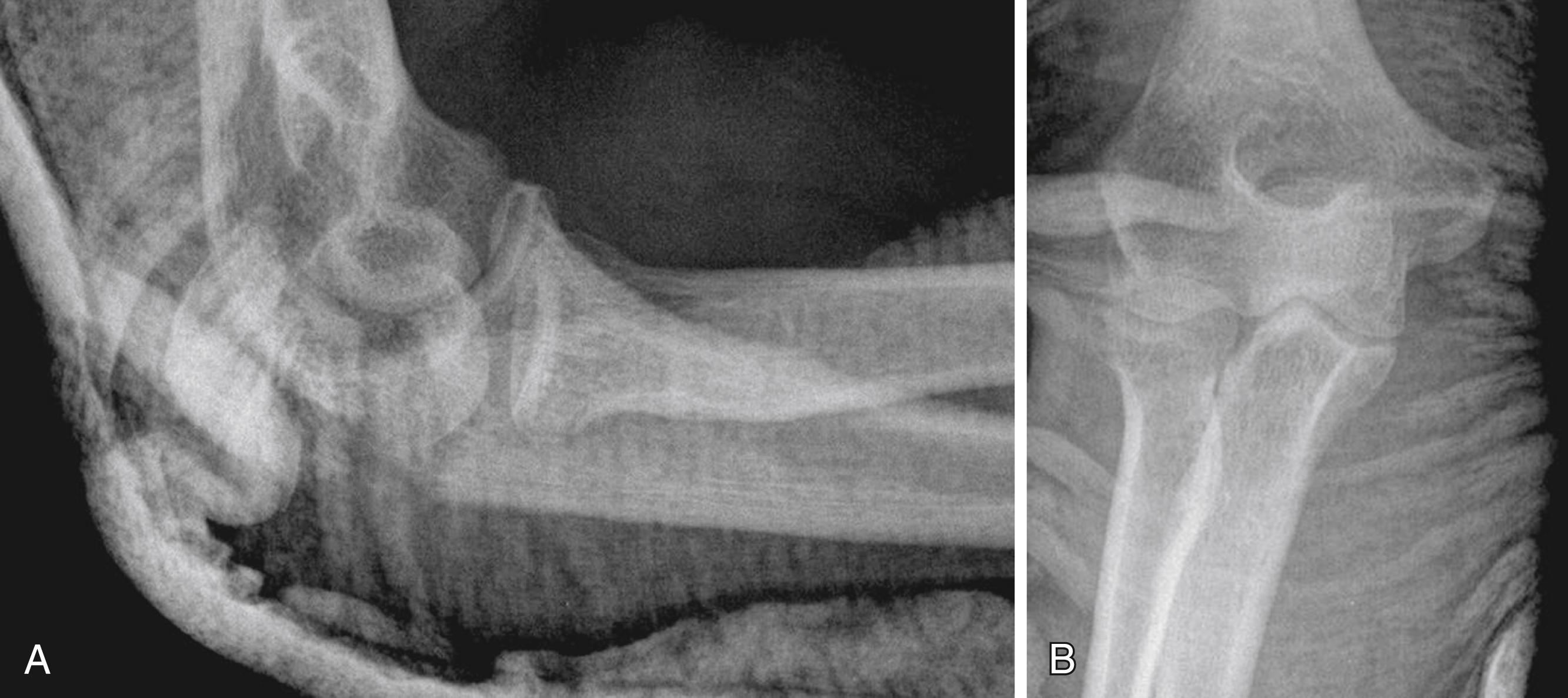 eFig. 20.20, A and B, A simple fracture of the olecranon after splinting.