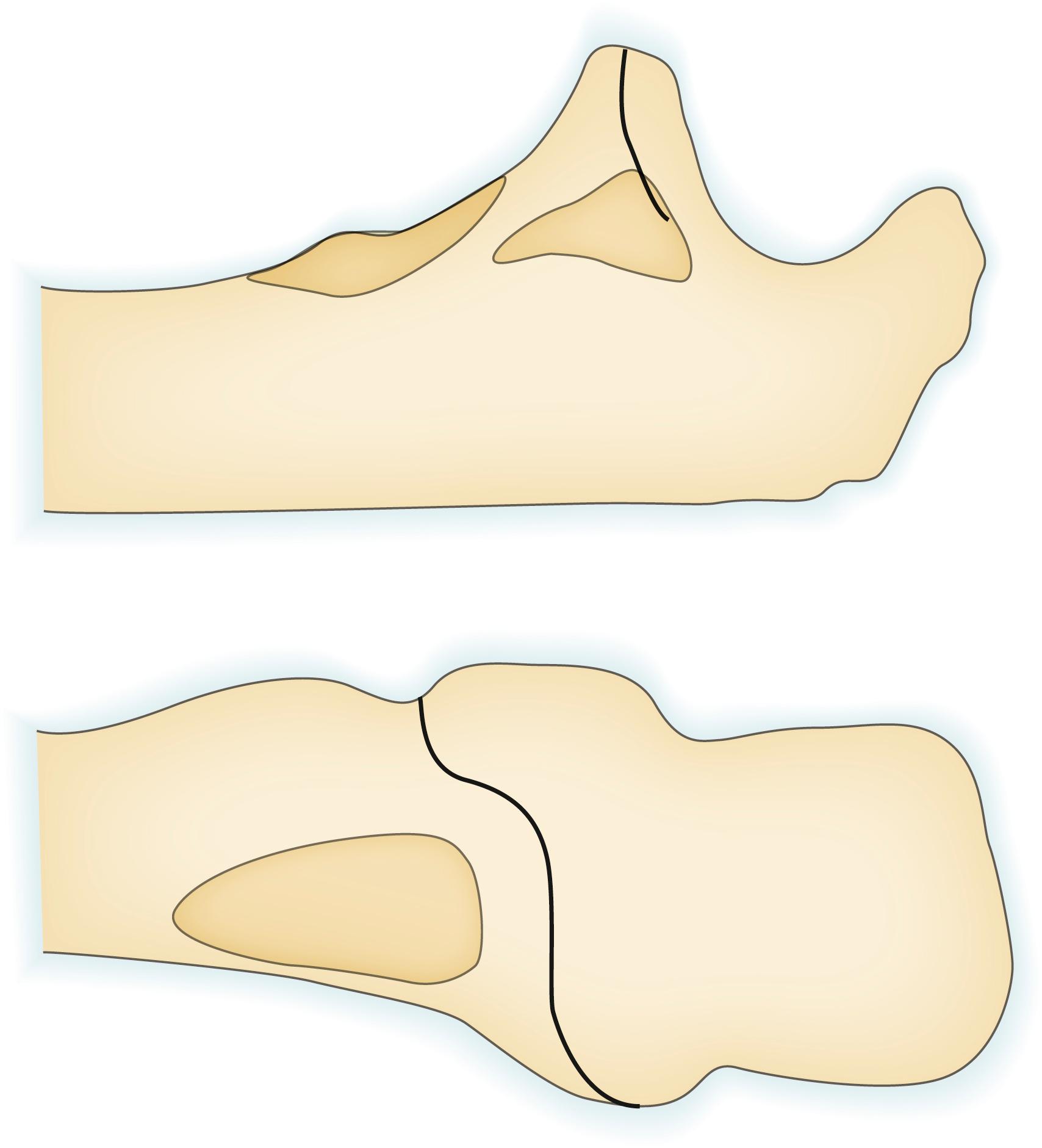 Fig. 20.3, Soft tissue attachments to the coronoid. The brachialis has a broad and very distal insertion that goes beyond the coronoid and is therefore not disrupted by coronoid fractures. The anterior band of the medial collateral ligament inserts at the base of the coronoid process so that only a very large or medial-sided coronoid fracture will involve the medial collateral ligament insertion. The anterior elbow capsule inserts a few millimeters below the tip of the coronoid process; however, even coronoid fractures that are very small on radiographs nearly always remain attached to the capsule.