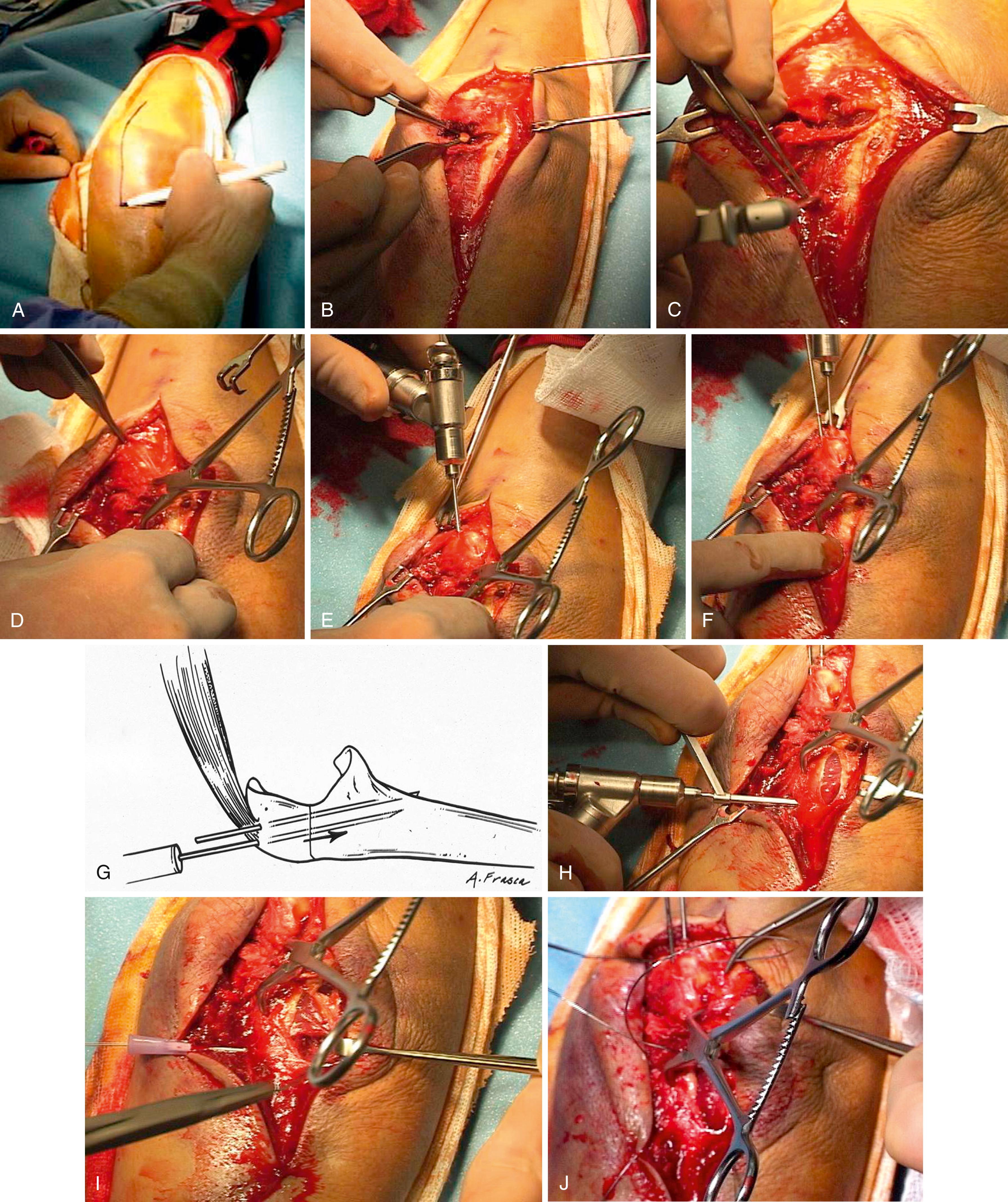 eFig. 20.21, Tension band wiring. A, A straight dorsal skin incision is used. B, The fracture site was opened and a loose articular fragment was removed and discarded. C, A dorsal drill hole was made in the ulna distal to the fracture site as an anchor point for a reduction forceps. D, Fracture reduction is maintained with a reduction clamp. E and F, Kirschner wires are drilled across the olecranon obliquely. G, The Kirschner wires engage the anterior ulnar cortex distal to the coronoid process. H, Two drill holes are made in the ulna distal to the fracture site. I, A large-gauge needle is used to pass 22-gauge wires through the drill holes. J, A needle is also used to pass the wires beneath the triceps insertion proximal to the Kirschner wires. The tension wires are placed in a figure-of-eight pattern over the dorsal ulna. K to N, The wires were tensioned both medially and laterally. O and P, The proximal ends of the wires were bent 180 degrees and trimmed, and impaction into the proximal olecranon was achieved. Q, The security of the fixation is tested in flexion. R, Wound closure.