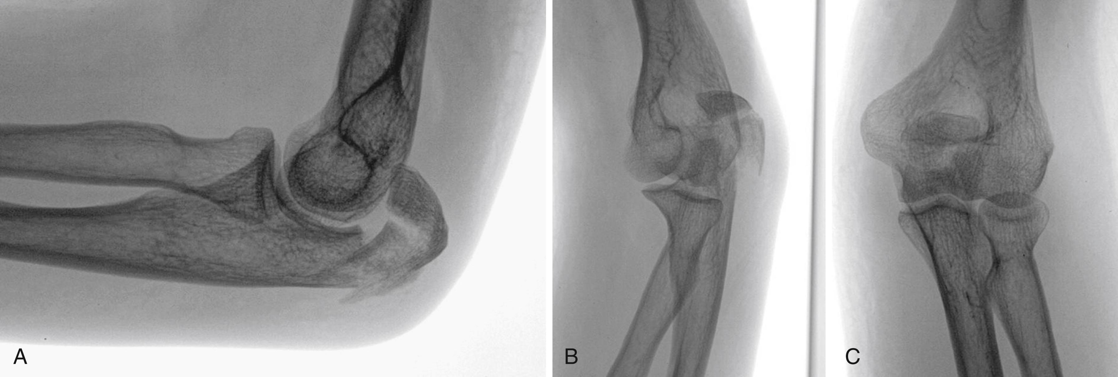 eFig. 20.23, A to C, Radiographs of comminuted fracture of the olecranon without associated fractures or dislocations in a 35-year-old woman.