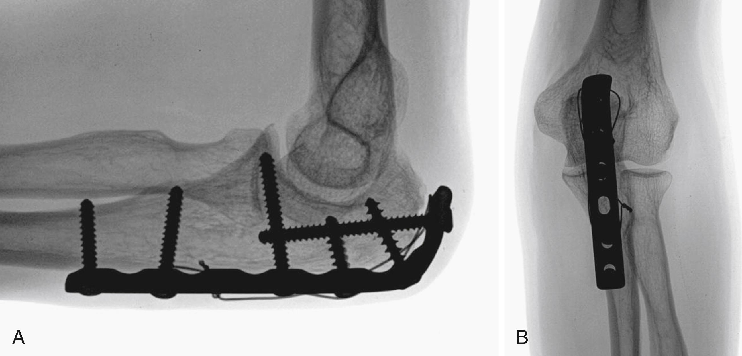 eFig. 20.24, A and B, The plate is applied to the dorsal surface of the ulna and contoured around the proximal olecranon. A tension wire engaging the triceps insertion can enhance fixation. Functional motion was obtained.