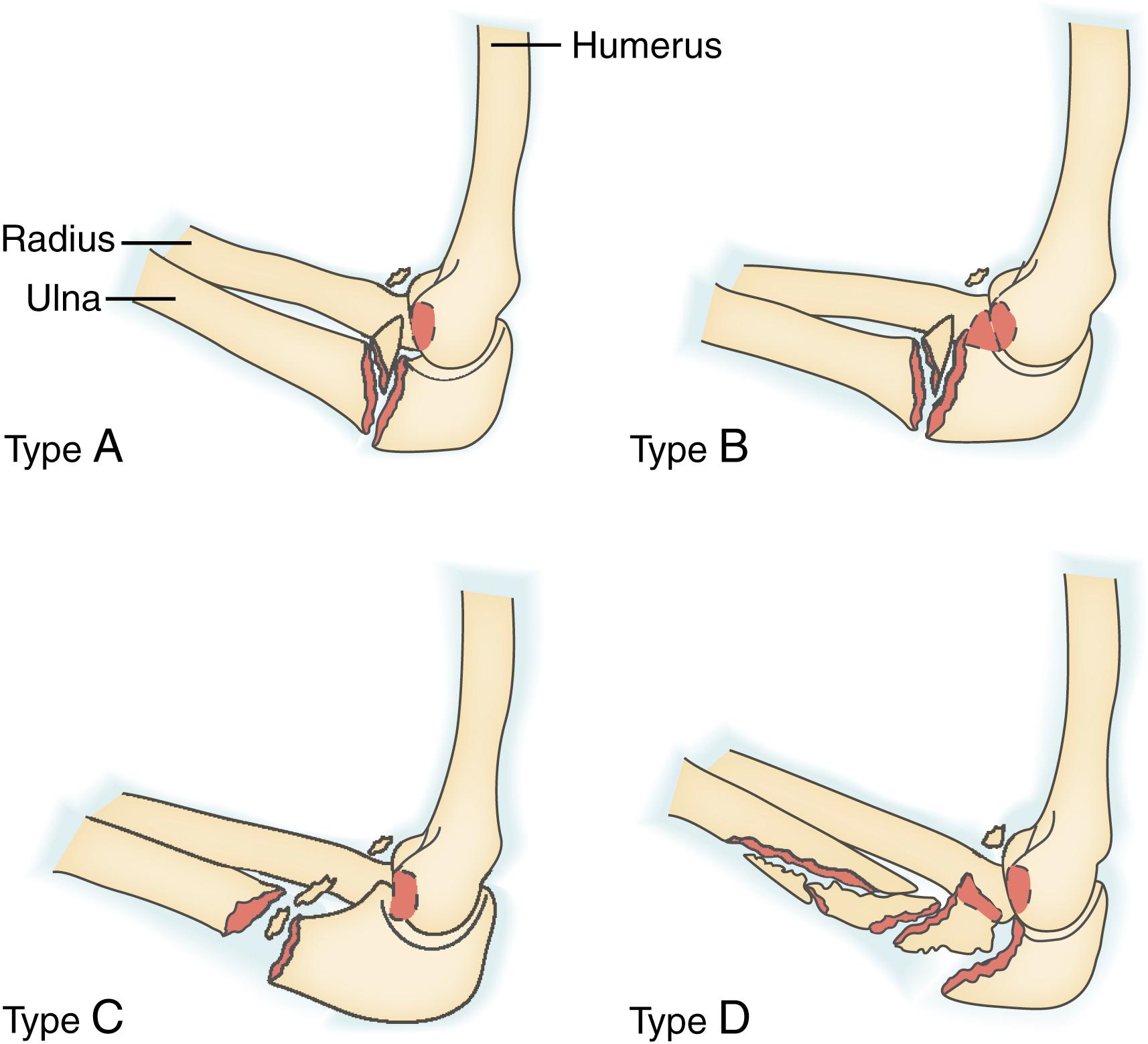 Fig. 20.4, Illustration of a spectrum of posterior Monteggia injuries. Type A: injury at the ulnohumeral joint with fractures of the olecranon and coronoid; type B: injury at the most common location, the proximal ulnar metaphysis; type C: injury at the diaphyseal level; type D: complex fractures that involve multiple levels.