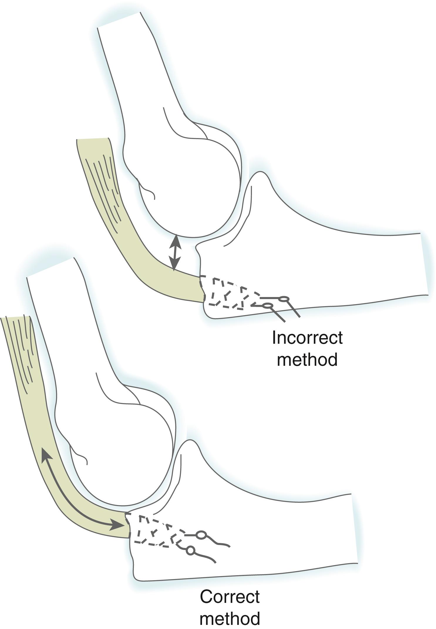 Fig. 20.5, When the triceps is advanced and reattached to the proximal ulna after olecranon excision, it is better to insert it close to the articular margin.