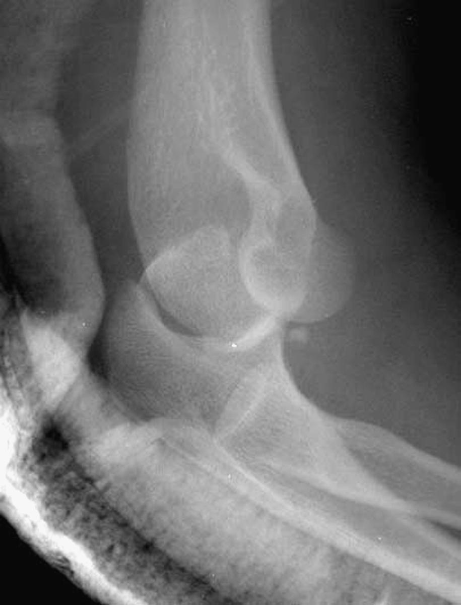 Fig. 20.6, In this unusual case, a patient has sustained a posterior dislocation of the elbow associated with a fracture of the olecranon process on the medial aspect, essentially avulsing the posterior aspect of the medial collateral ligament complex.