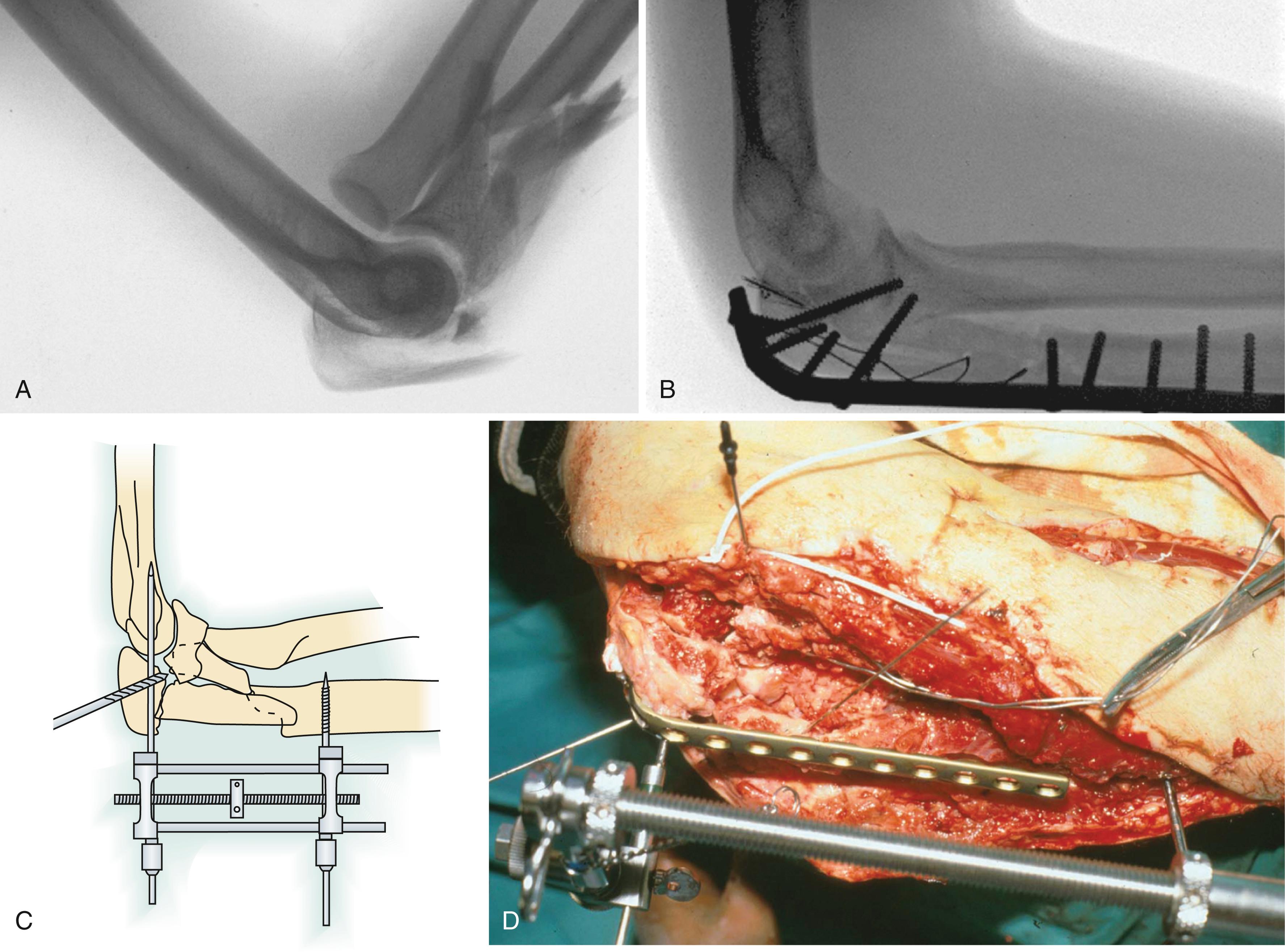 Fig. 20.7, Anterior (transolecranon) fracture-subluxation of the elbow. A, The forearm is displaced anteriorly with the radioulnar relationship relatively spared. The trochlea has imploded through the proximal ulna, creating a very complex fracture with a large coronoid fracture and comminution extending into the diaphysis. The collateral ligaments are usually not injured. B, A long contoured dorsal plate secures the relationship between the coronoid and olecranon processes (the contour and dimensions of the trochlear notch) and bridges the comminution. A tension wire engages the fragmented olecranon process. C, As described by Mast, an external fixator can assist with reduction and provisional fixation. D, The olecranon fragment is held to the trochlea with a stout smooth Kirschner wire. Distraction between this wire and a second distal wire helps realign the intervening fragments.