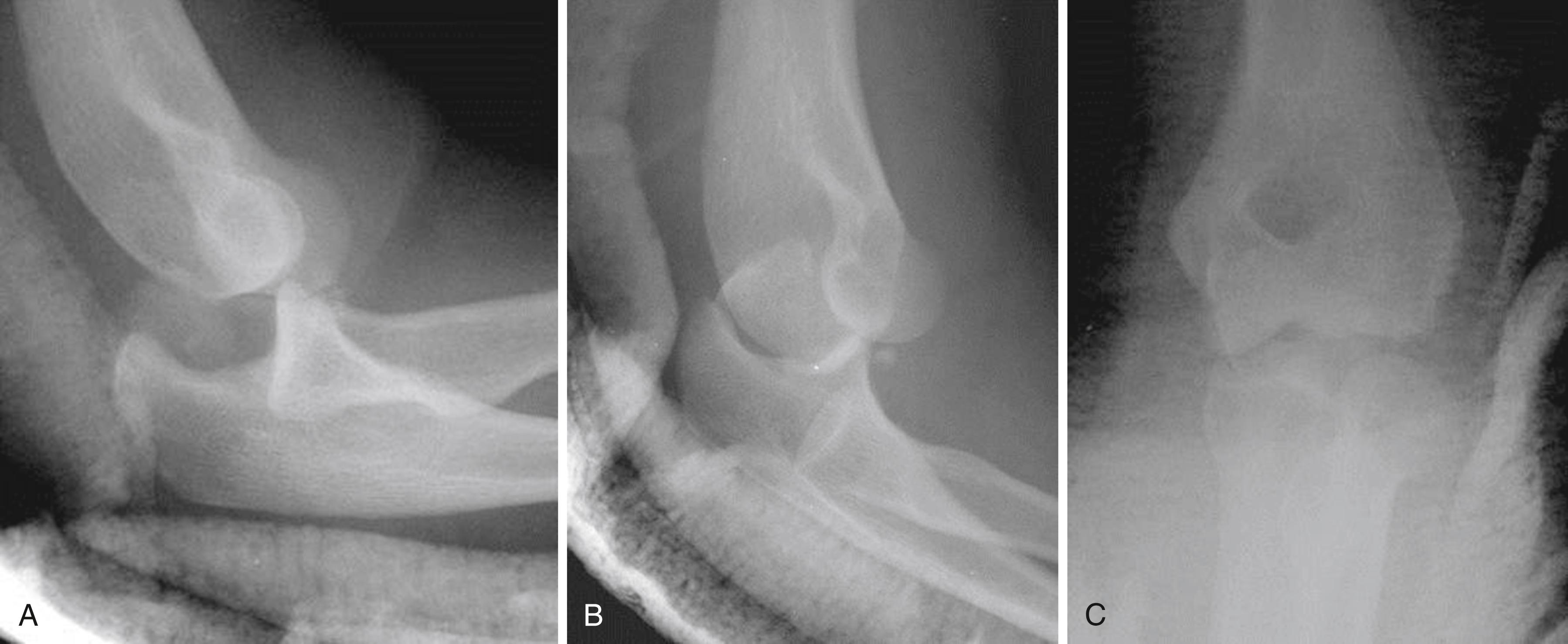 eFig. 20.1, A to C, This posterior dislocation of the elbow is associated with a fracture of the olecranon process on the medial aspect, essentially avulsing the posterior aspect of the medial collateral ligament complex.