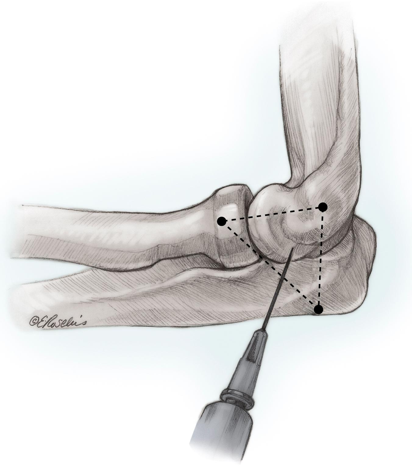 Fig. 19.1, Aspiration of the elbow. Under a sterile technique with the forearm maintained in pronation, a needle is introduced into the center of a triangle formed by the lateral epicondyle, radial head, and tip of the olecranon. The hemarthrosis is aspirated, and local anesthetic is injected. An improvement in rotation is suggestive of pain-limiting motion, whereas a persistent restriction of rotation is suggestive of a mechanical block requiring surgical management.