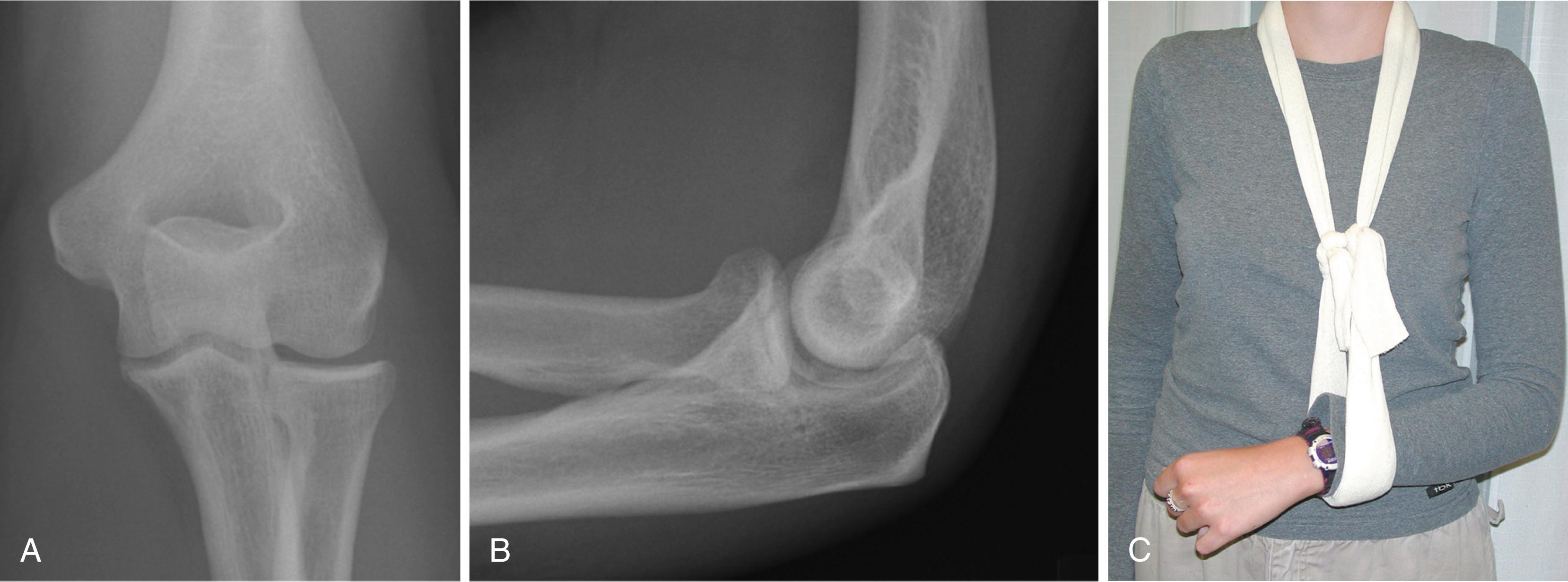 Fig. 19.11, Nondisplaced fracture. Anteroposterior (A) and lateral (B) radiographs of a 28-year-old woman with a nondisplaced fracture of the radial neck. C, Management with a collar and cuff sling. The patient had a complete return of motion and no residual pain.