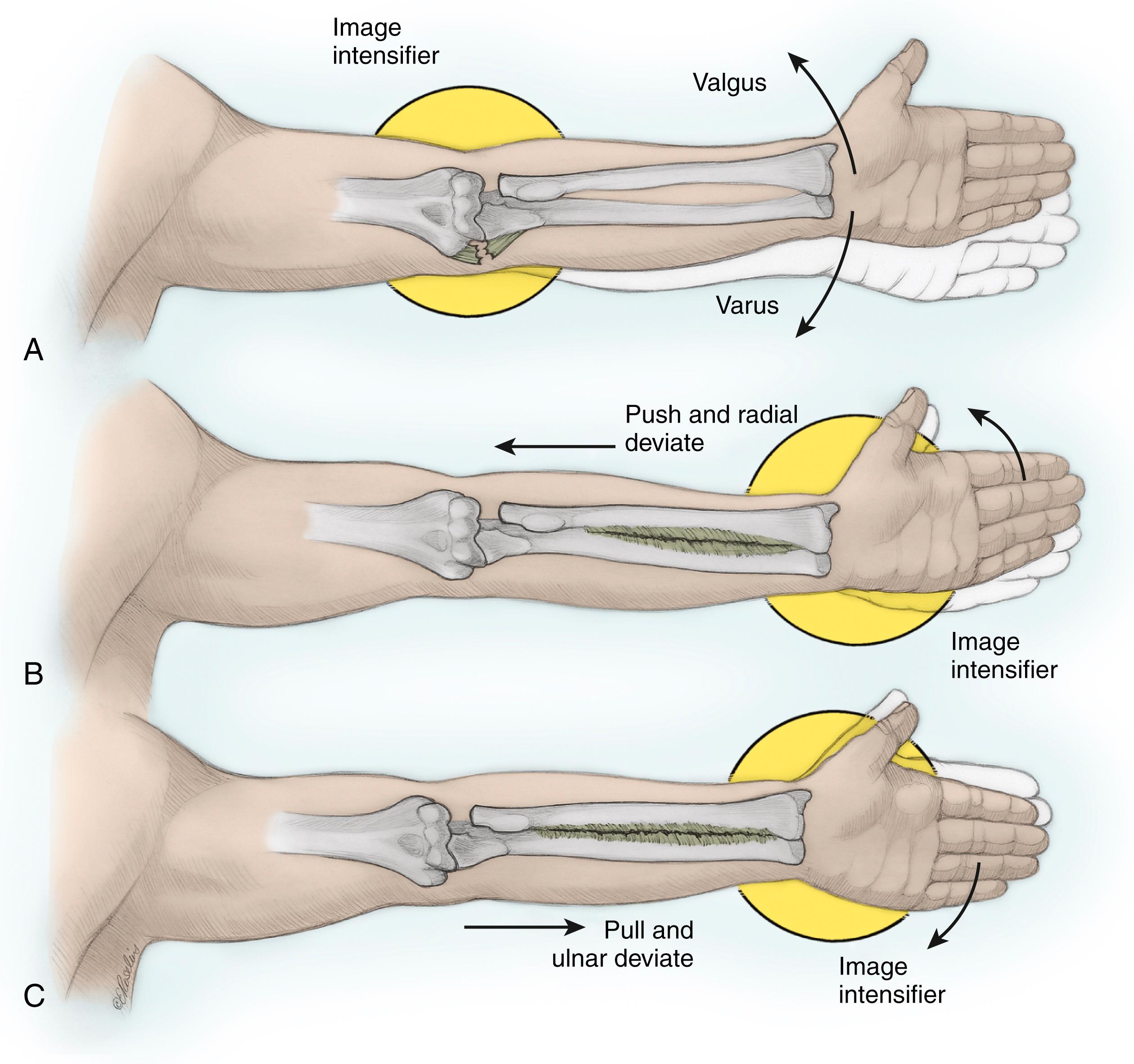 Fig. 19.12, A, A valgus and varus stress test of the elbow should be performed to evaluate the integrity of the medial and lateral collateral ligaments using an image intensifier before excision of the radial head. B and C, Similarly, the axial stability of the forearm should be evaluated by alternatively applying axial traction/ulnar deviation and compression/radial deviation to the forearm and wrist while monitoring ulnar variance at the wrist with an image intensifier.