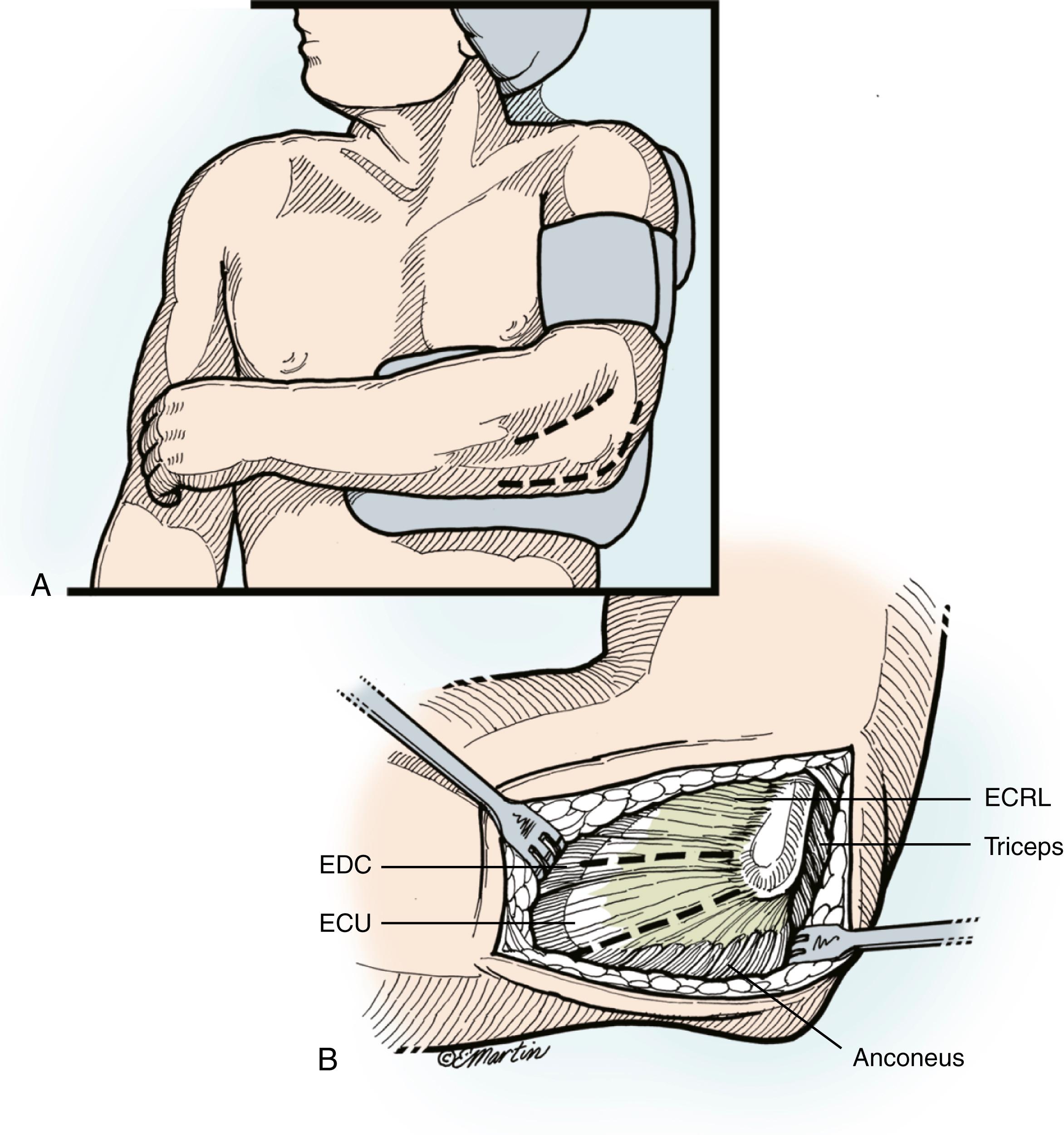 Fig. 19.13, Superficial surgical approaches. A, Posterior midline skin incision is employed just lateral to the tip of the olecranon. B, A full-thickness lateral flap is elevated. The use of this incision allows access to the medial aspect of the elbow (if necessary) to manage associated injuries to the medial collateral ligament or coronoid, is less obvious due to its location, and has a low incidence of cutaneous nerve injury. Alternatively, a lateral incision can be employed at the surgeon’s discretion. Exposure of the radial head can be obtained using either a Kocher approach between the anconeus and extensor carpi ulnaris or a more anterior common extensor tendon split. ECRL, Extensor carpi radialis longus; ECU, extensor carpi ulnaris; EDC, extensor digitorum communis.