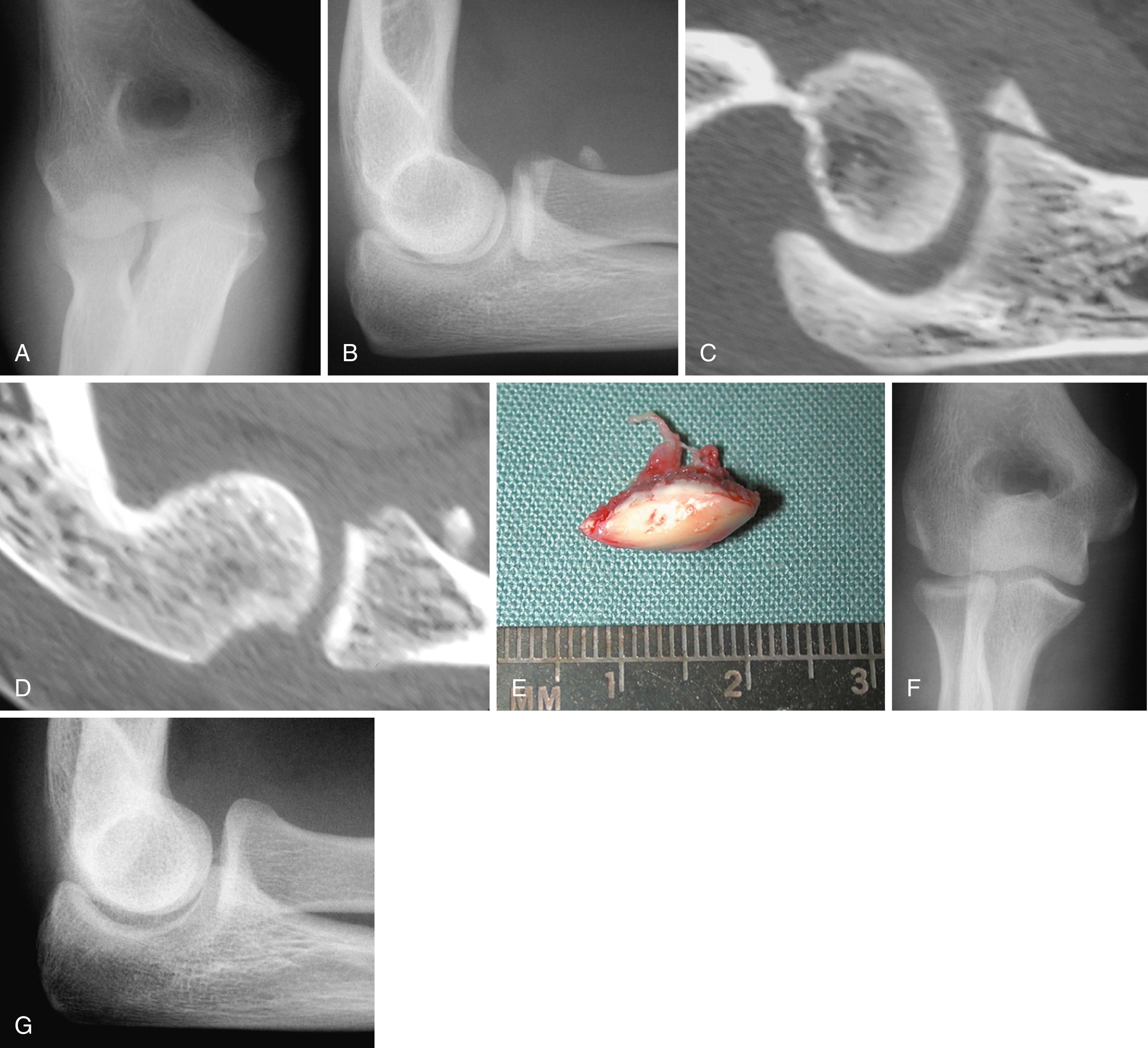Fig. 19.16, Excision of a fragment of the radial head. Anteroposterior (A) and lateral (B) radiographs of a 32-year-old man who fell while rollerblading; he had limited prosupination. C and D, CT scan demonstrated a nondisplaced coronoid fracture, a posterior capitellum impression fracture, and a fragment of the radial head anterior to the radial neck. E, Attempts to retrieve the fragment arthroscopically failed due to its location distal to the radial head, and an arthrotomy was needed to excise the small fragment. F and G, After a lateral ligament repair and early range-of-motion exercises, the patient recovered a full arc of forearm rotation and a functional arc of elbow motion.