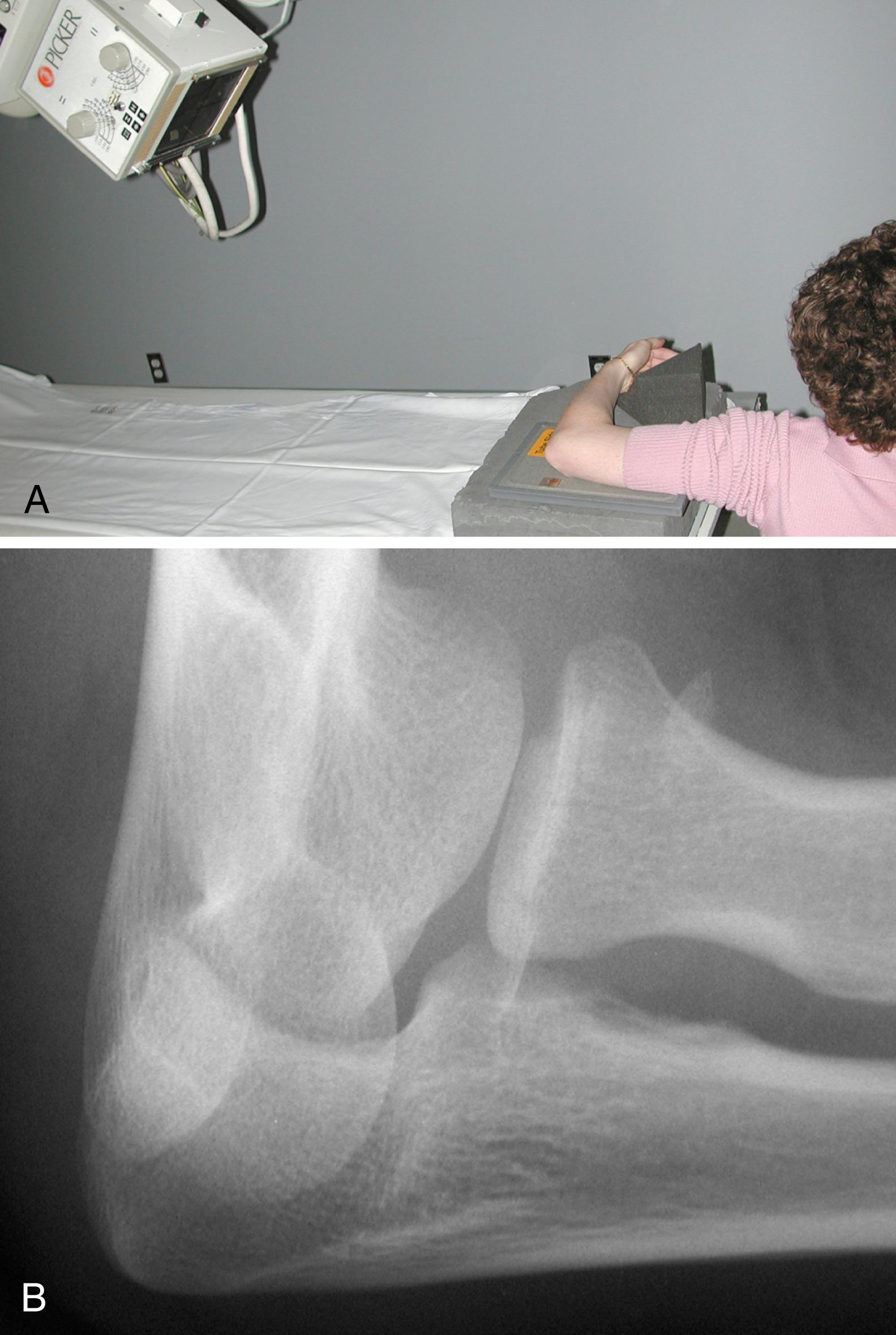 Fig. 19.2, The radiocapitellar view can be useful because it places the radial head in profile. A and B, The elbow is positioned for a lateral radiograph, but the x-ray tube is angled 45 degrees cephalad.