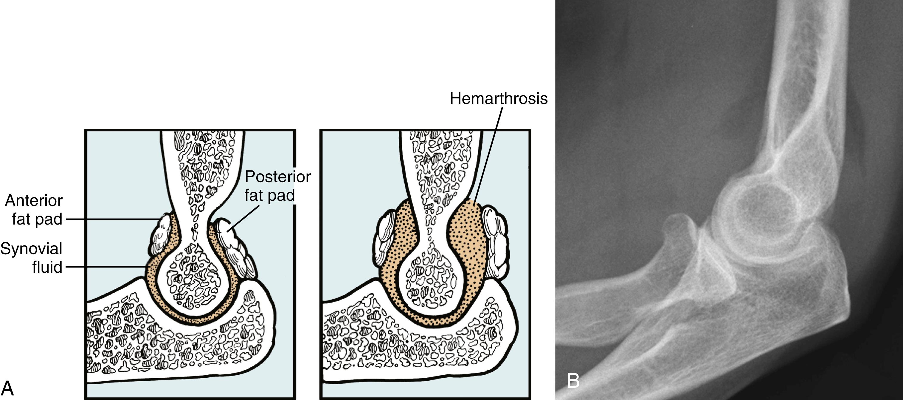 Fig. 19.3, Fat pad sign. A, Normal position of fat pads in the elbow and displacement of fat pads induced by an intraarticular effusion. B, Lateral radiograph demonstrating anterior and posterior fat pad signs in patient with a nondisplaced fracture of the radial head.