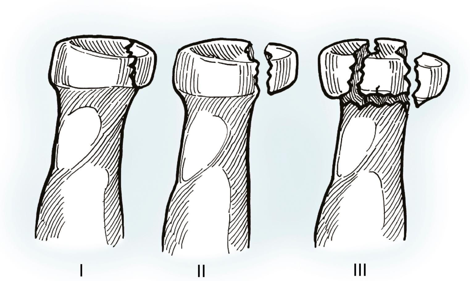 Fig. 19.4, Mason classification. Mason described three types of fractures of the radial head: I, nondisplaced; II, displaced wedge fragment(s); and III, comminuted.