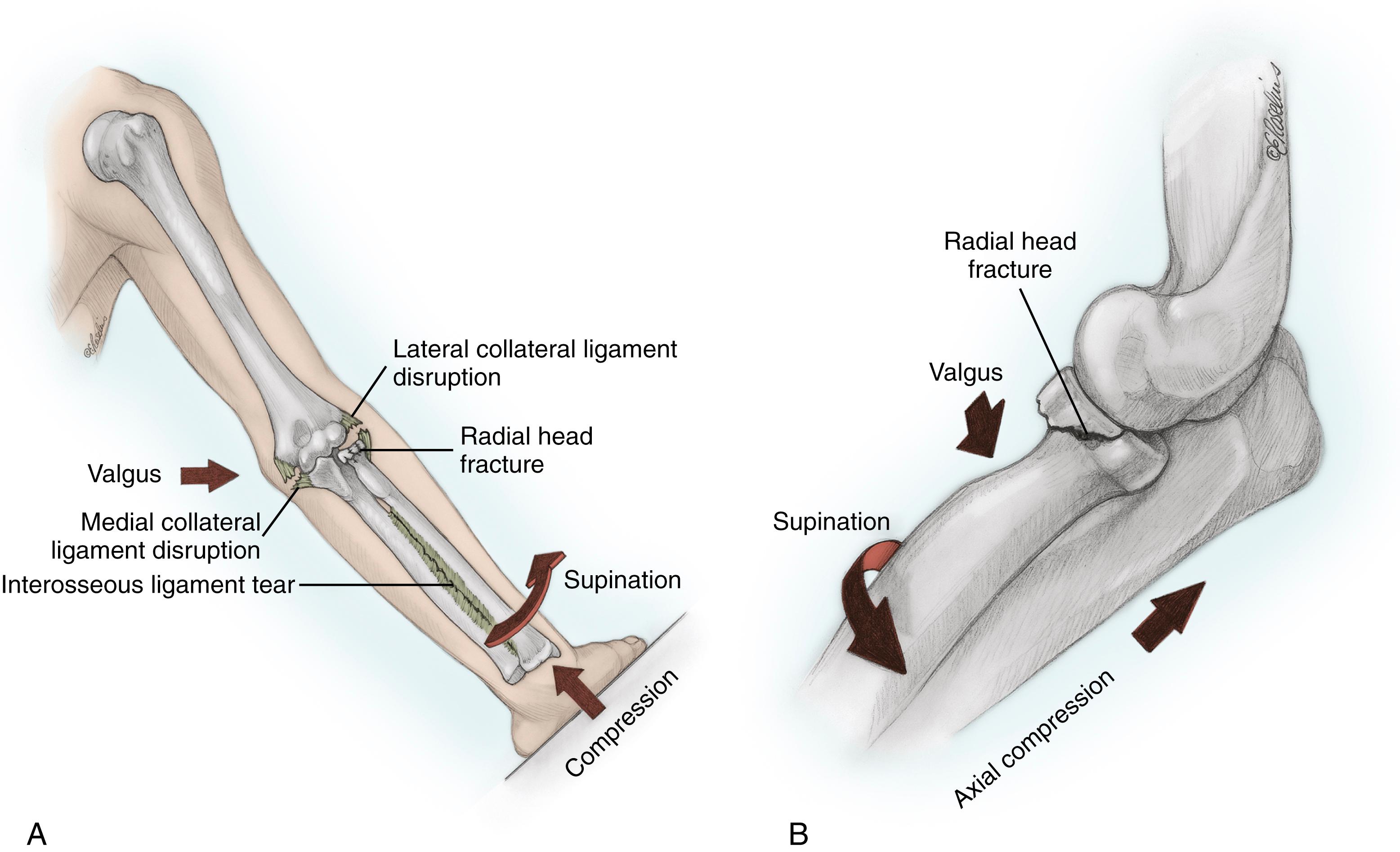 Fig. 19.5, Mechanism of fracture of the radial head. A, Valgus and/or axial loading of the elbow causes failure of the radial head in compression and possible medial collateral ligament or interosseous membrane disruption. B, Posterolateral rotatory subluxation of the elbow causes disruption of the lateral ulnar collateral ligament and the anterolateral aspect of the radial head to shear off as it slides posterior to the capitellum with the forearm in supination. This mechanism likely explains the commonly associated lateral ligamentous injuries and chondral damage of the capitellum seen with this fracture pattern. Continued subluxation of the elbow may result in a fracture of the coronoid, disruption of the medial collateral ligament, and a complete dislocation.